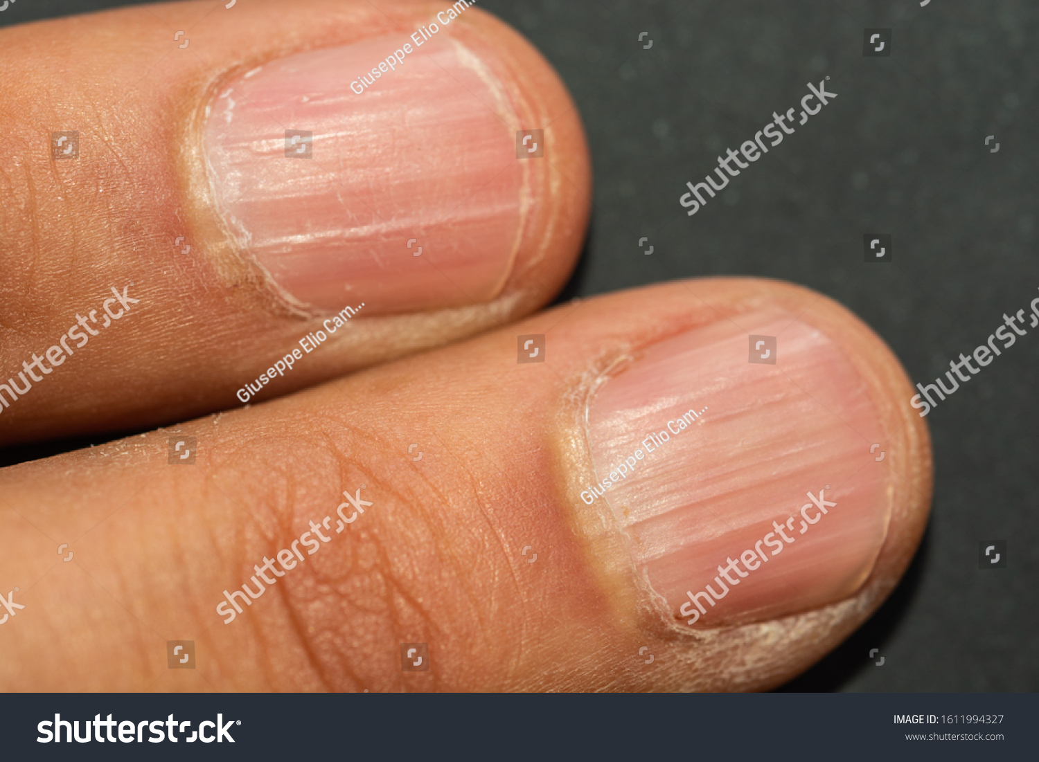 Vertical Ridges On Fingernails Symptoms Deficiency Stock Photo