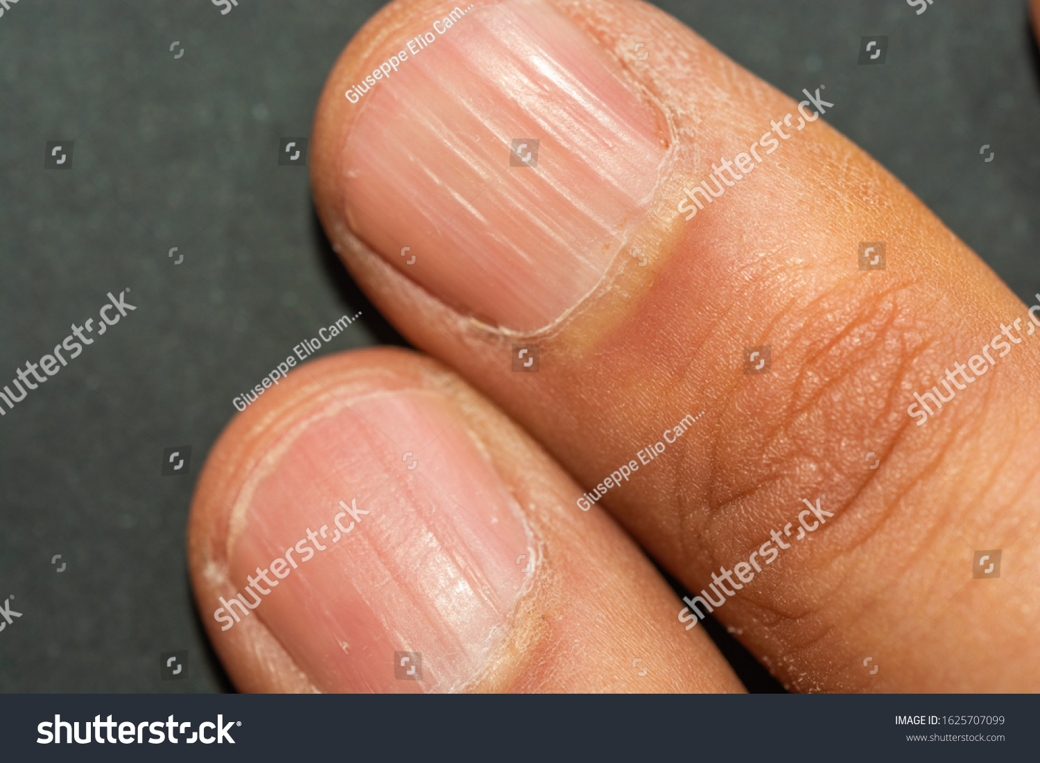 Vertical Ridges On Fingernails Symptoms Deficiency Stock Photo