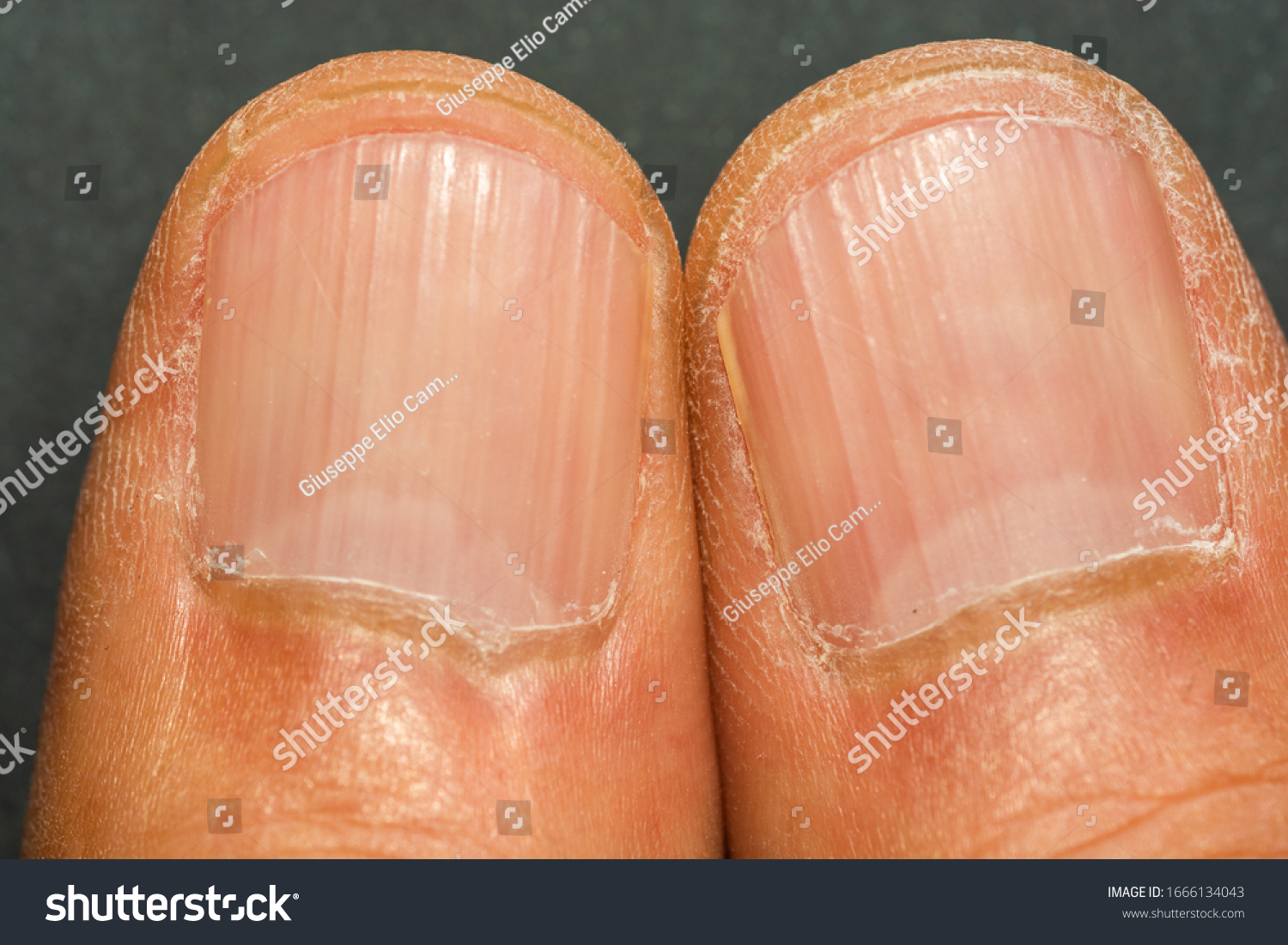 vertical-ridges-on-fingernails-symptoms-deficiency-stock-photo-1666134043-shutterstock