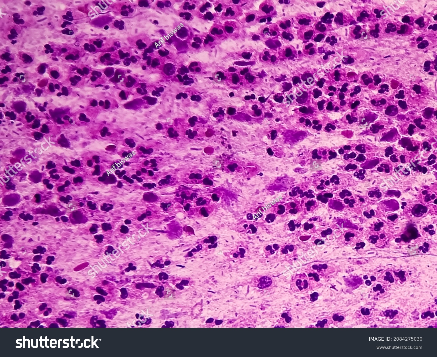 View Microscopic Koilocyte Cell Criteria Hpv Stock Photo 2084275030 ...