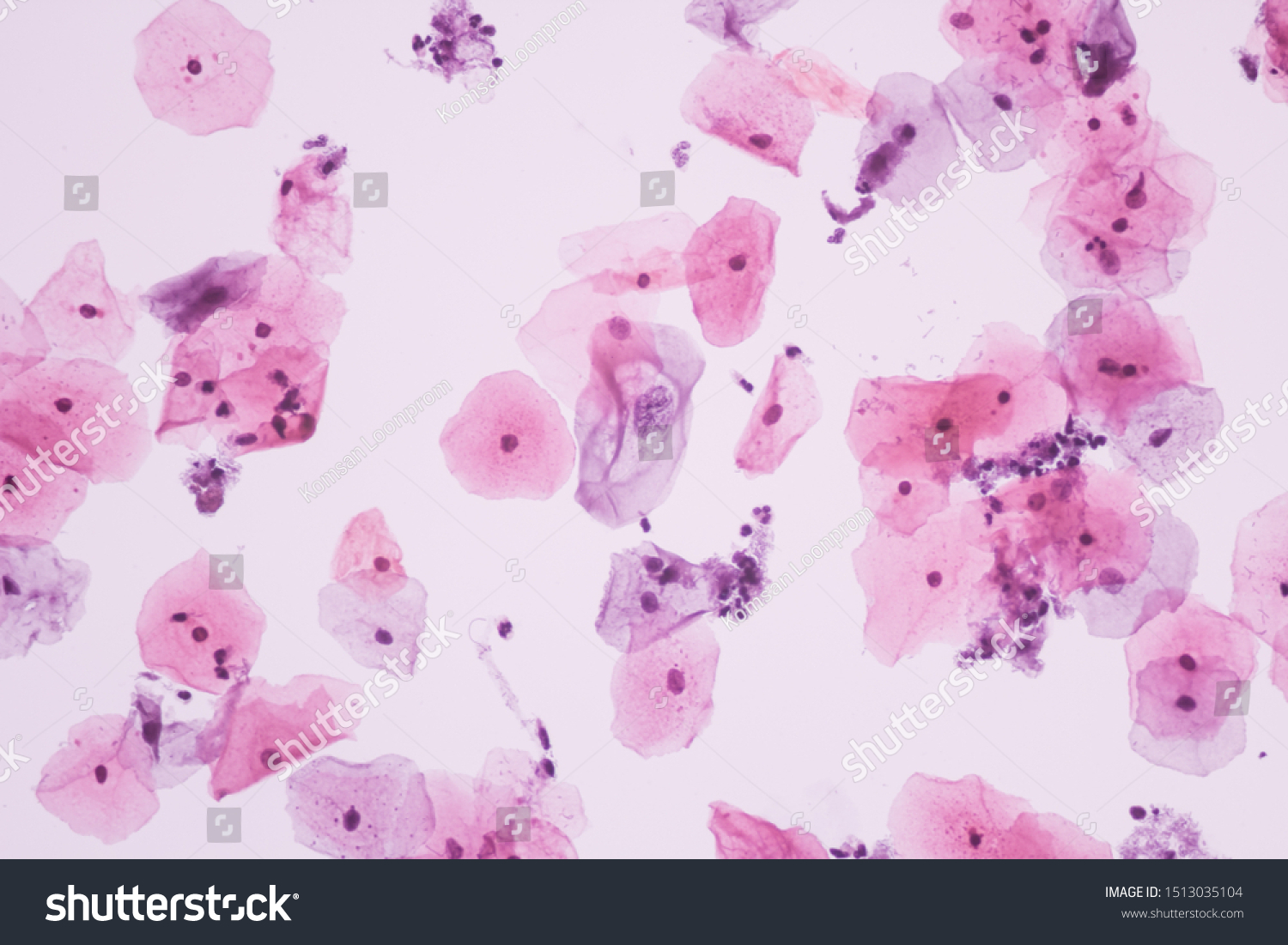 View Microscopic Abnormal Human Cervix Cellskoilocyte Stock Photo ...