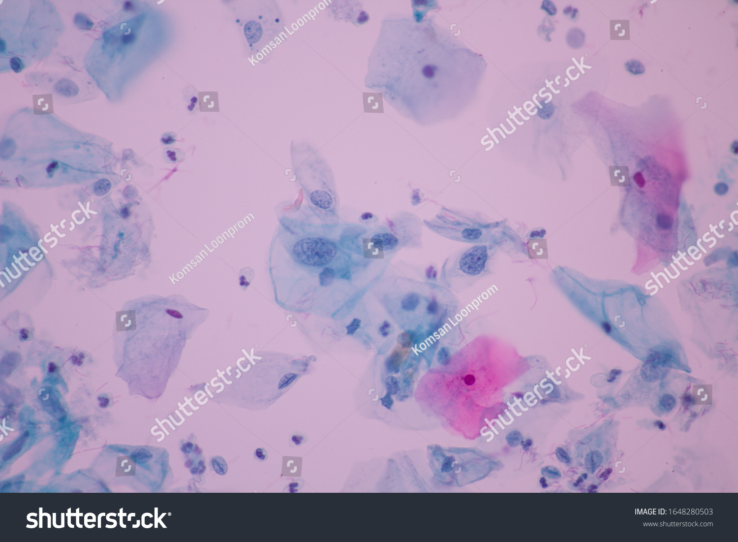 View Microscopic Abnormal Human Cervix Cellssquamous Stock Photo ...