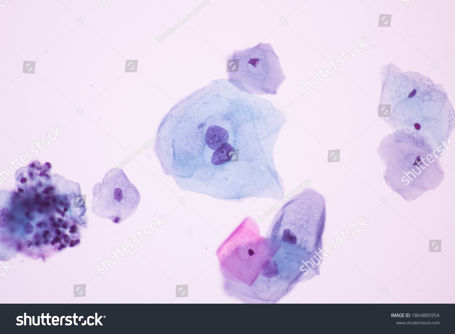 View Microscopic Abnormal Human Cervix Cellssquamous Stock Photo ...