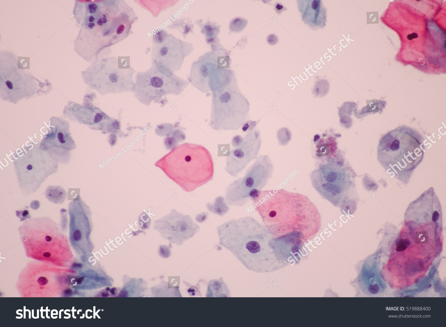 View Microscopic Trichomonas Spp Infection Pap Stock Photo (Edit Now ...