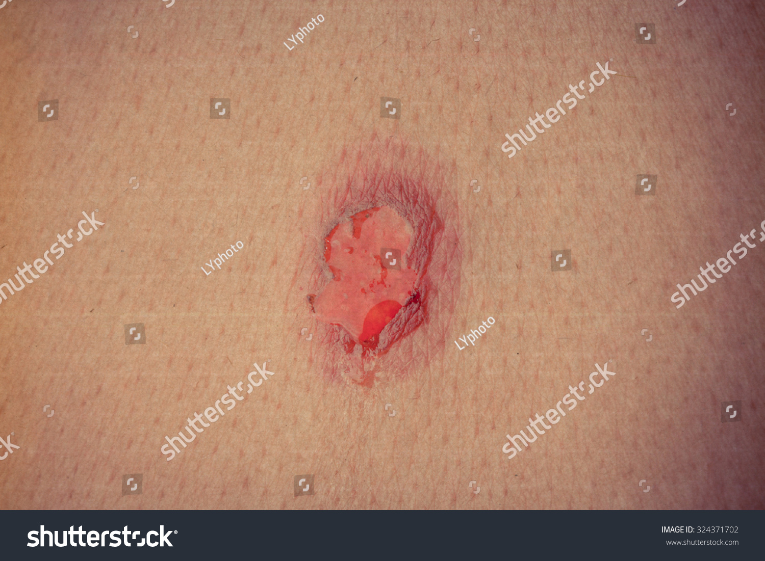 view-of-the-wound-on-the-skin-stock-photo-324371702-shutterstock