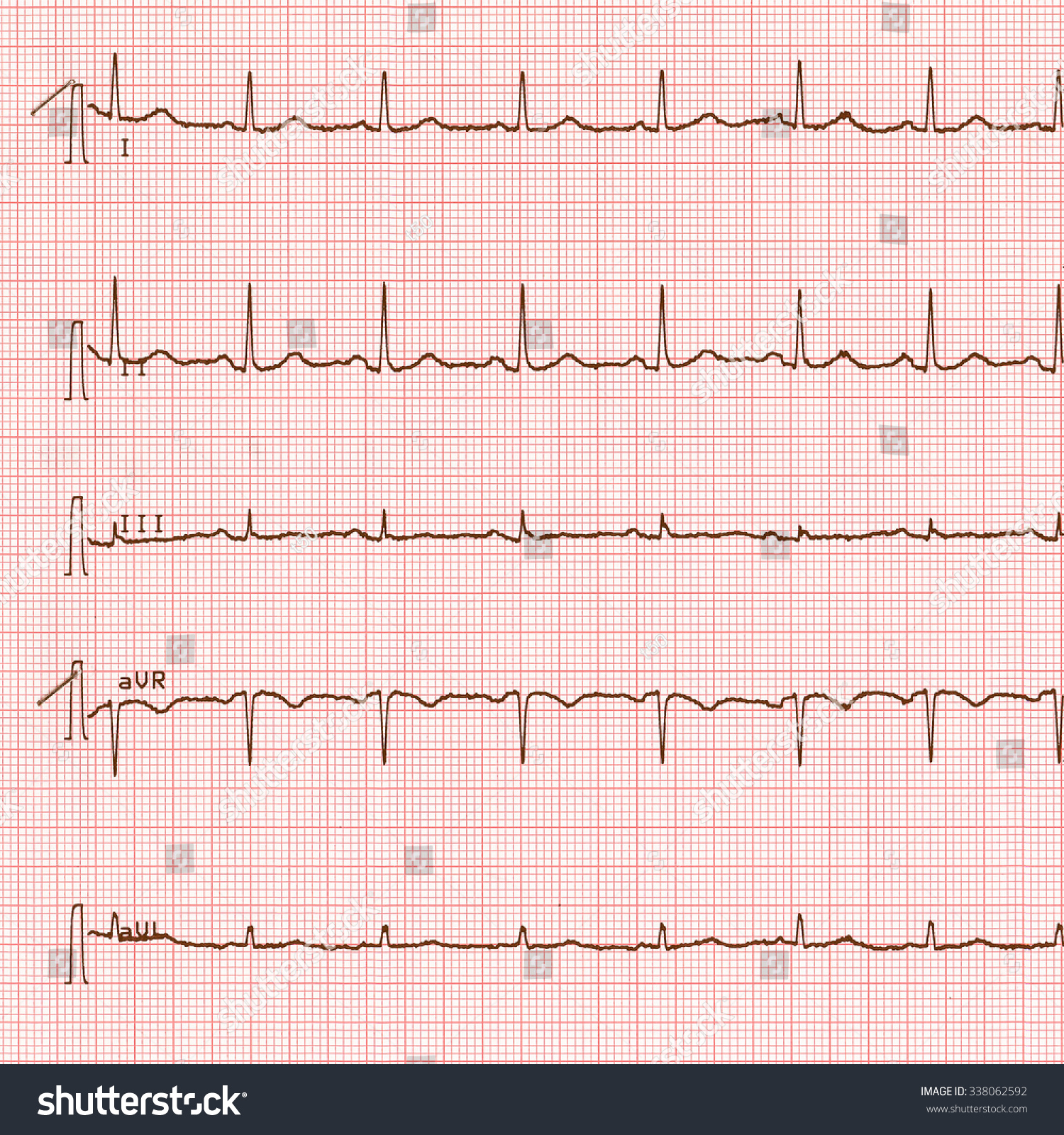 Vintage Looking Electrocardiography Aka Ekg Elektrokardiogramm Stock ...