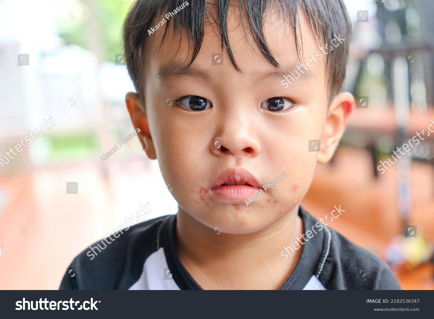 Viral Exanthem Infection On Boys Face Stock Photo 2182536347 | Shutterstock