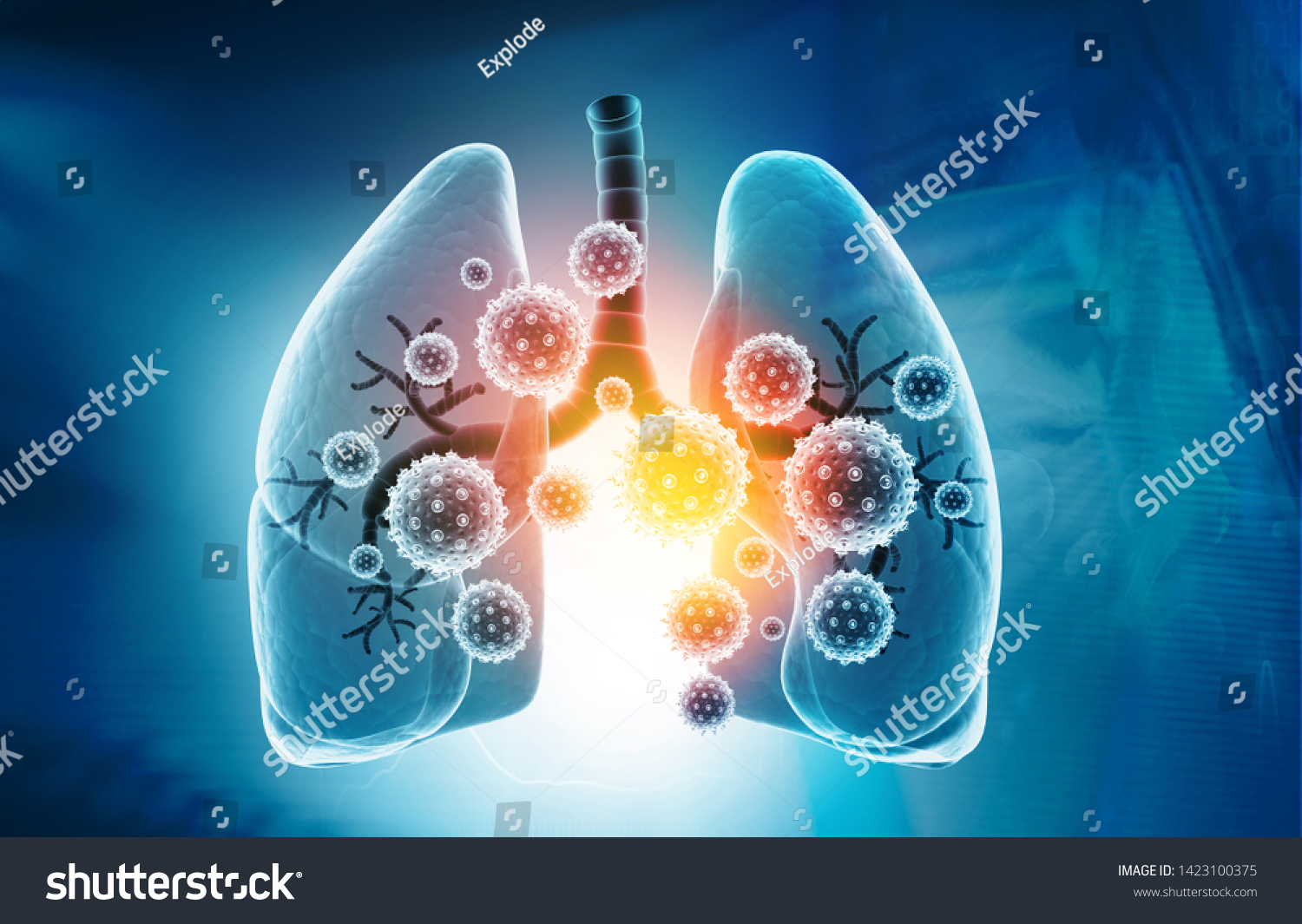 viral-lung-infections-lung-infection-conept-1423100375