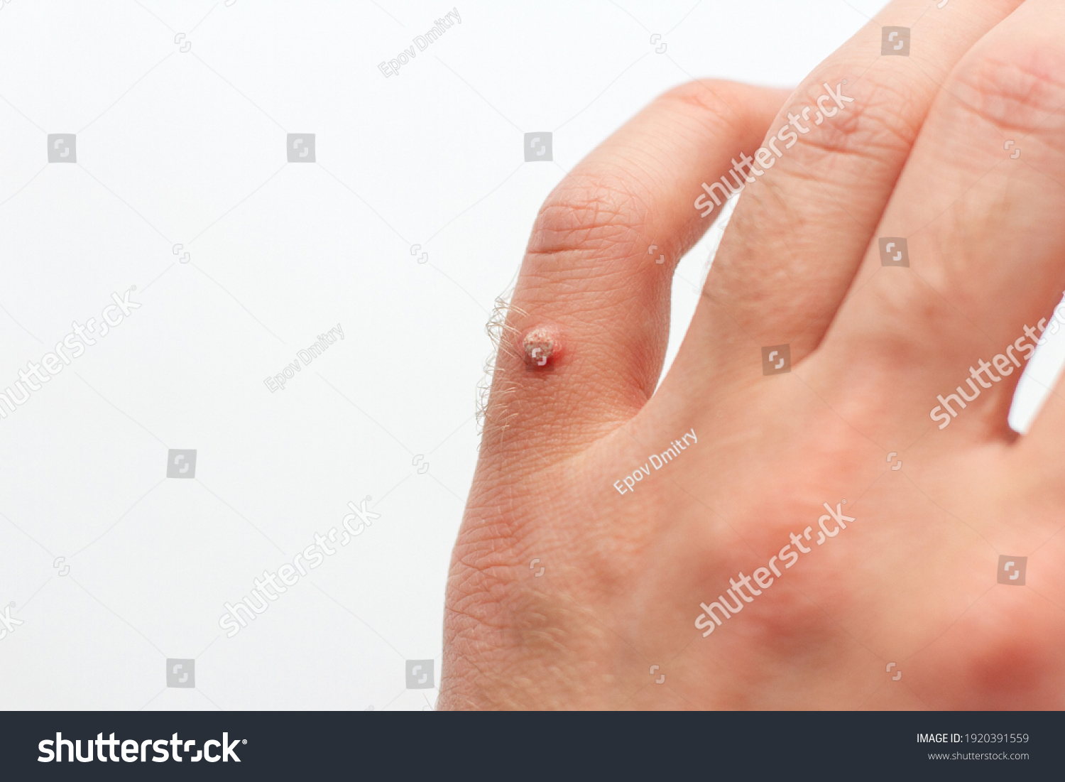 Viral Wart On Hand Finger Wart Foto Stock 1920391559 Shutterstock
