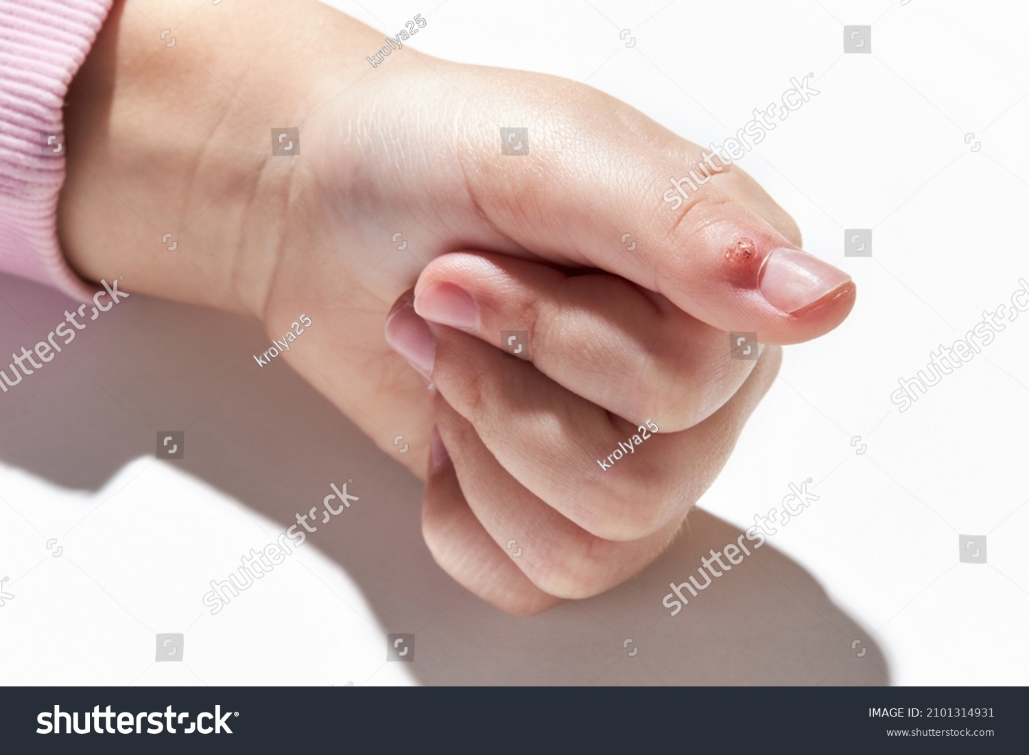 Viral Wart Verruca On Finger Close Stock Photo (Edit Now) 2101314931