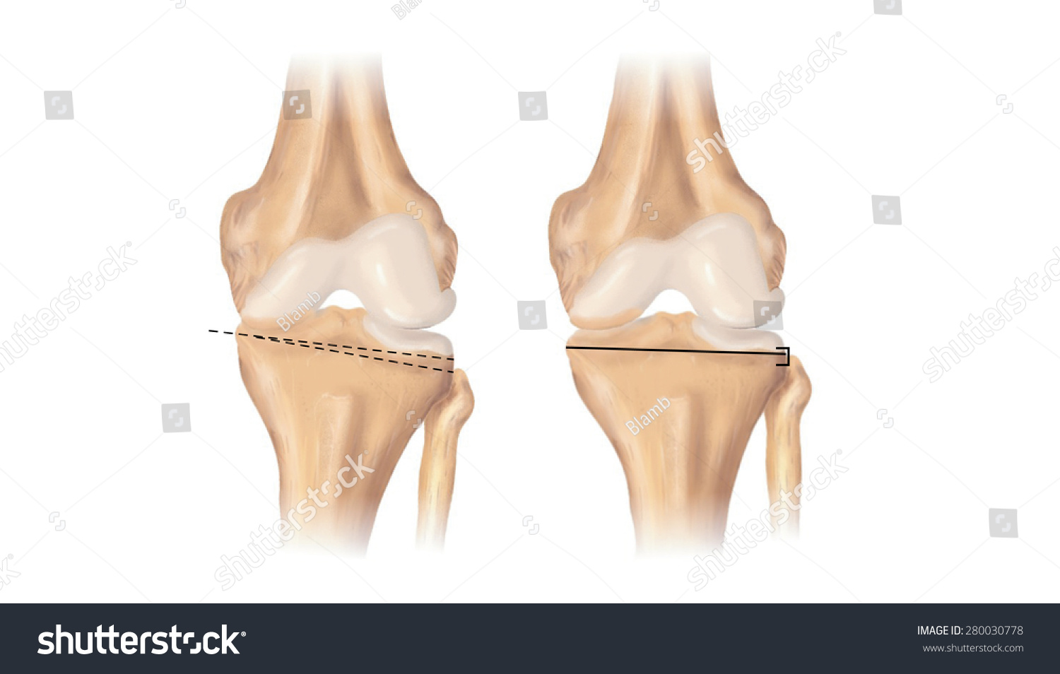 Wedge Bone Removed Knee Osteotomy Operation Stock Illustration 280030778