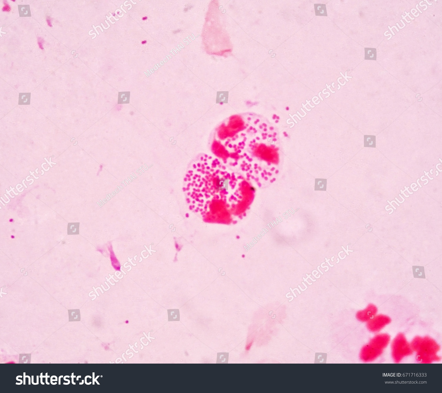 Diplococcus in the smear: what does it show Diplococcus in the smear: what does it show