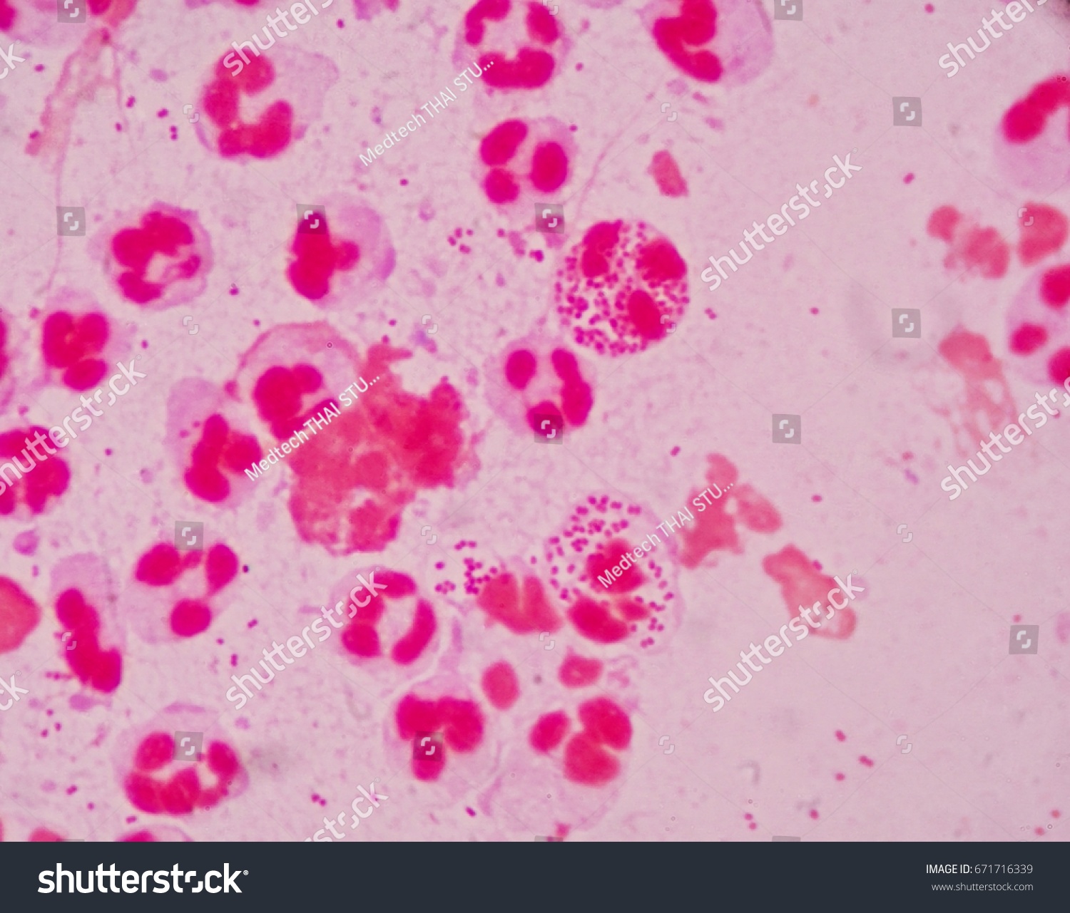 Diplococcus in the smear: what does it show Diplococcus in the smear: what does it show