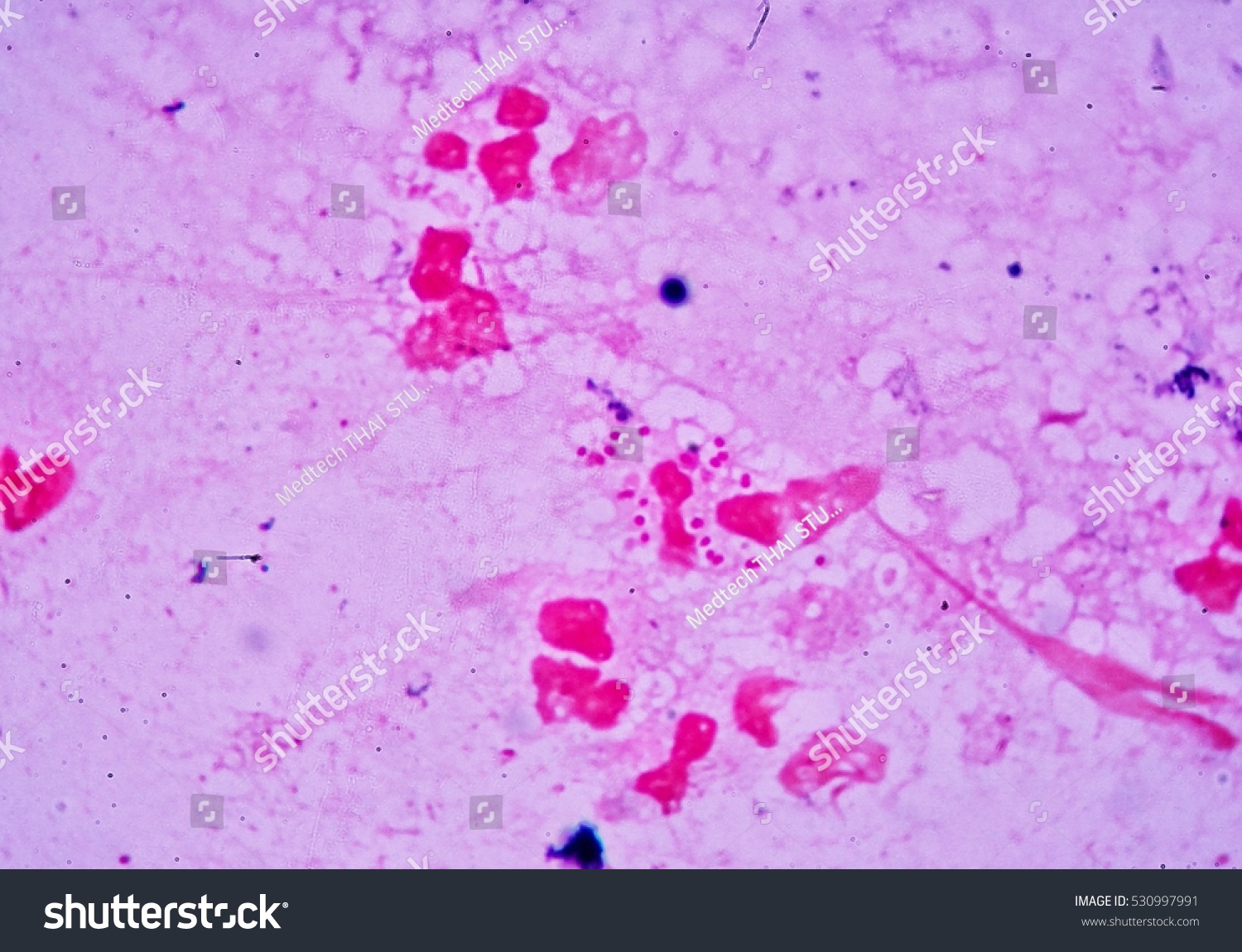 Diplococcus in the smear: what does it show Diplococcus in the smear: what does it show