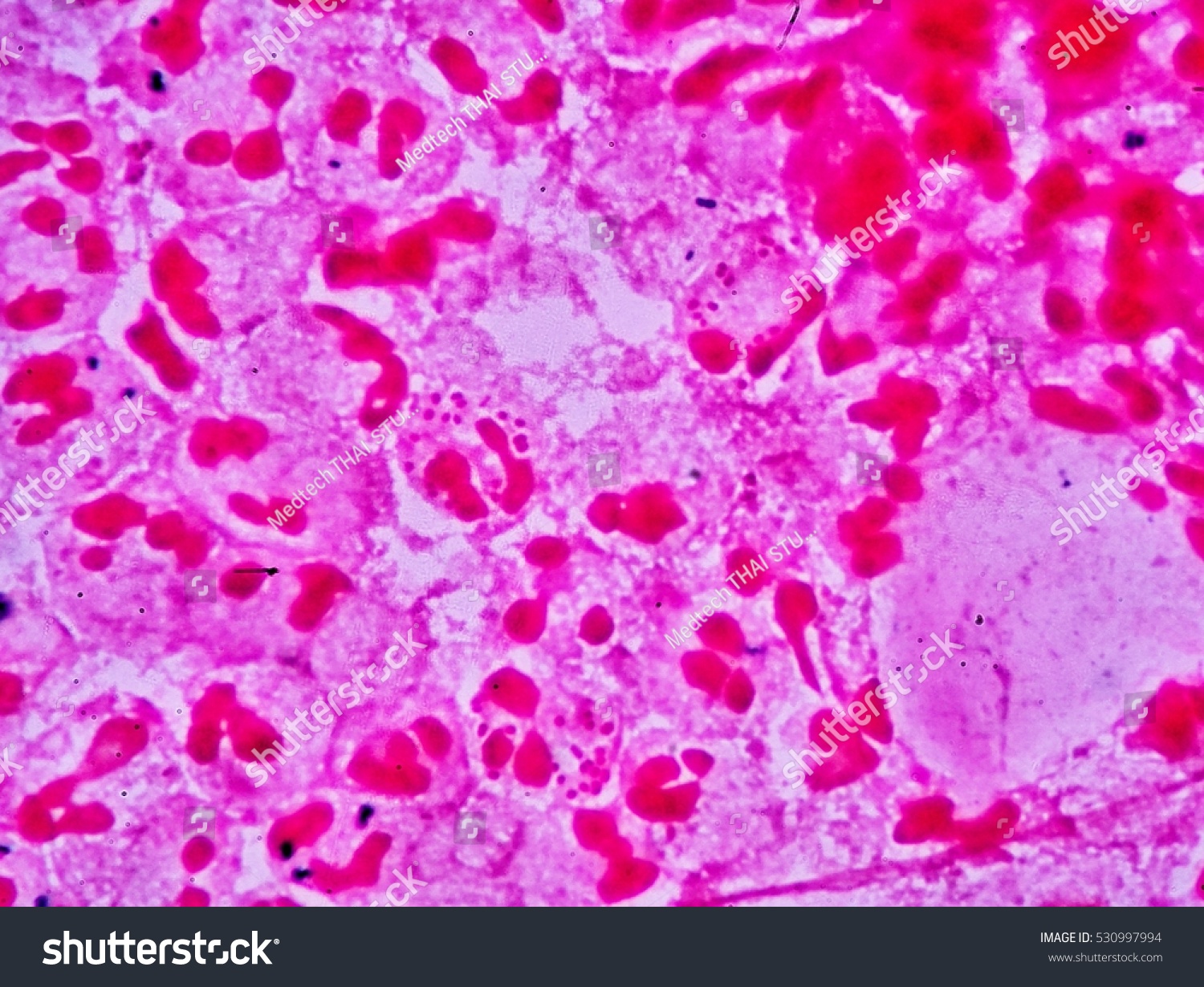 Diplococcus in the smear: what does it show Diplococcus in the smear: what does it show
