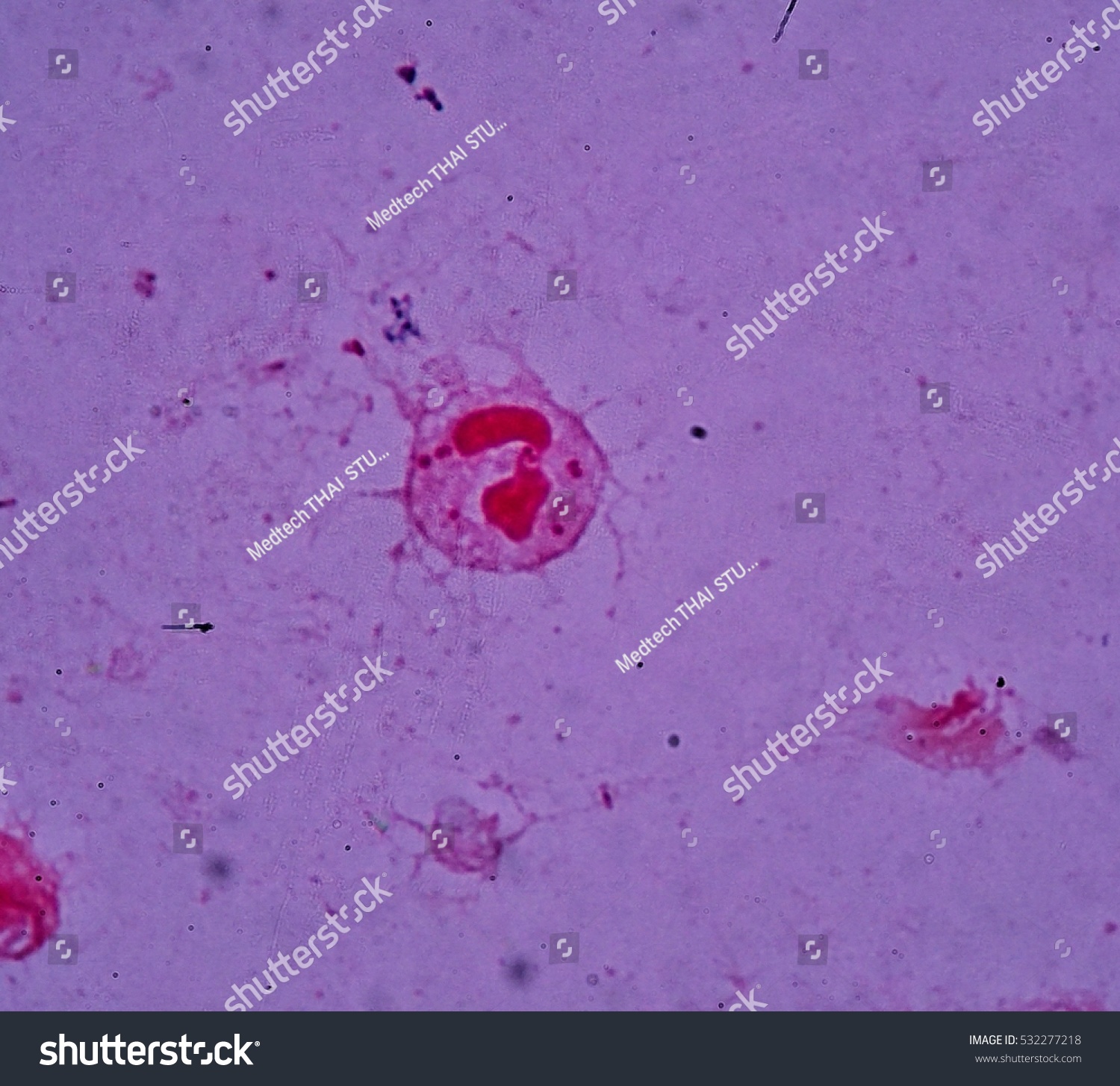 Diplococcus in the smear: what does it show Diplococcus in the smear: what does it show