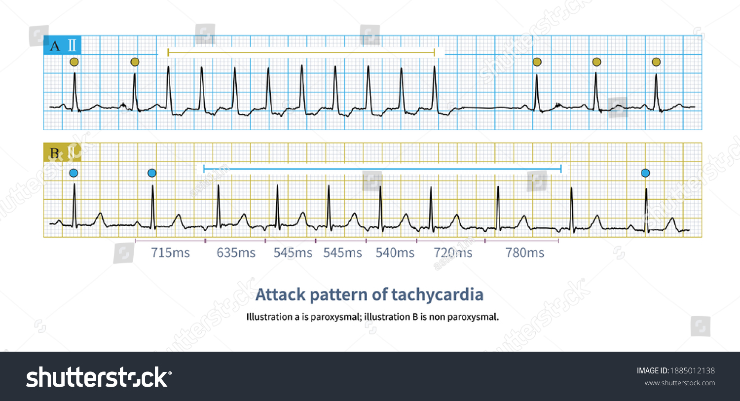 When Paroxysmal Tachycardia Occurs Heart Rate Stock Illustration 1885012138