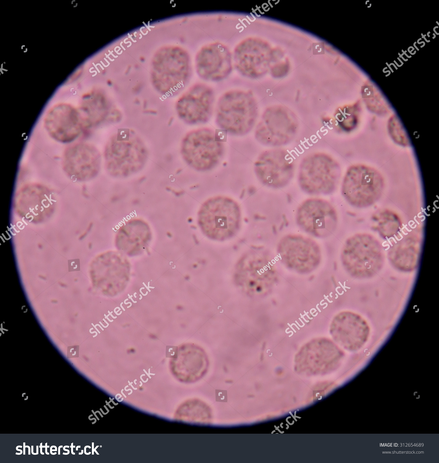 White Blood Cells In Urine Specimen Under Microscope 400x Stock Photo ...