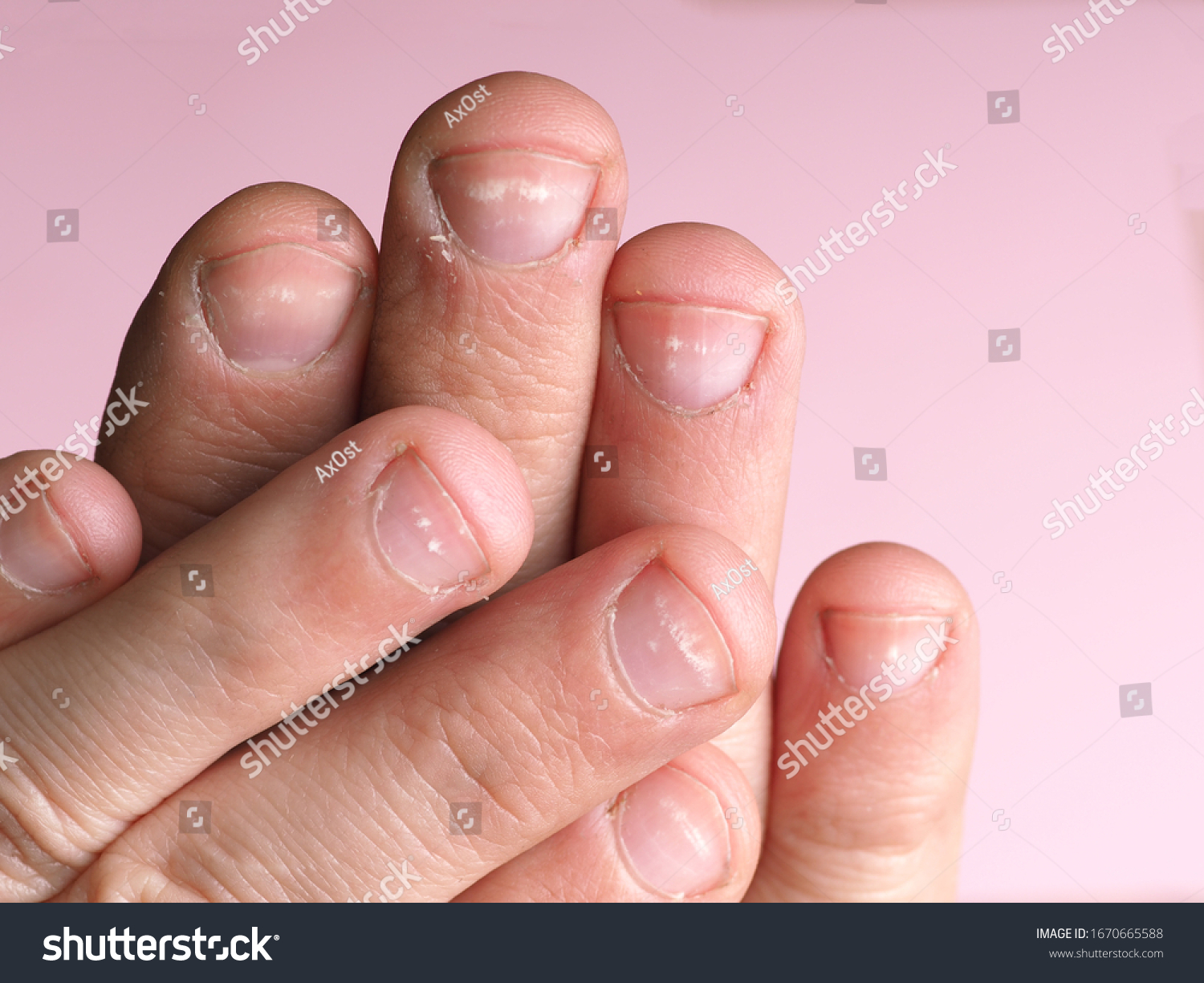 white-spots-on-nails-male-hand-stock-photo-edit-now-1670665588