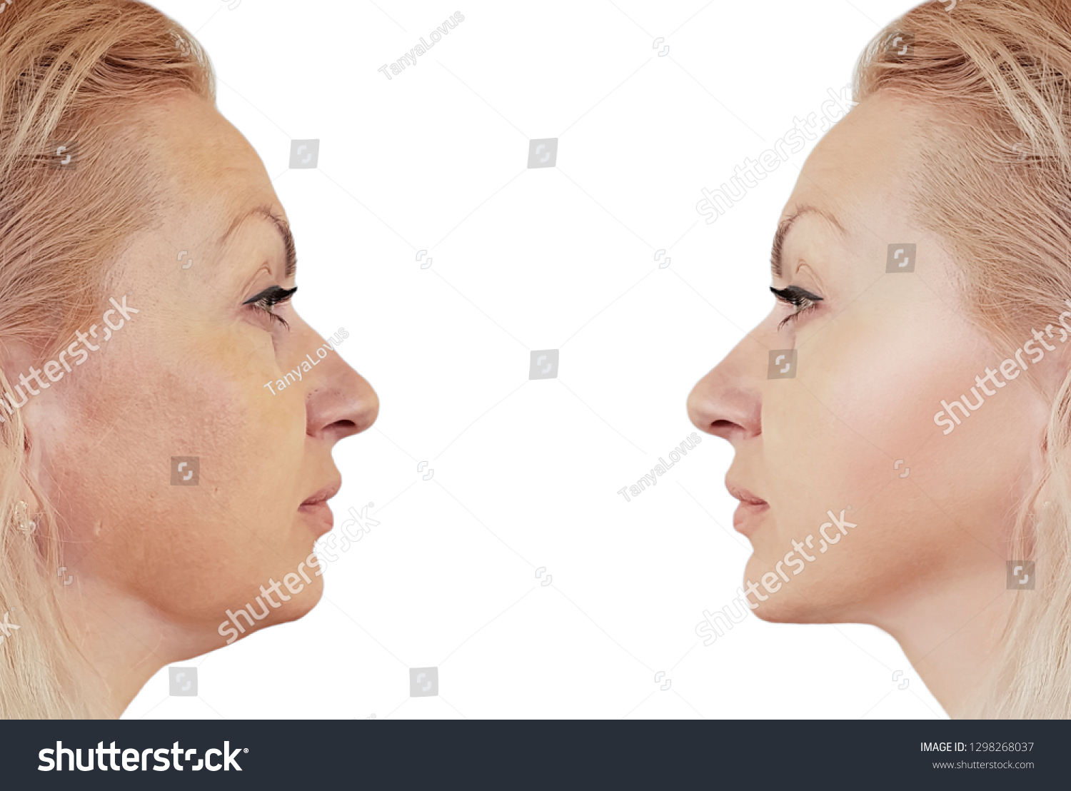 Woman Double Chin Before After Procedures Stock Photo Edit Now