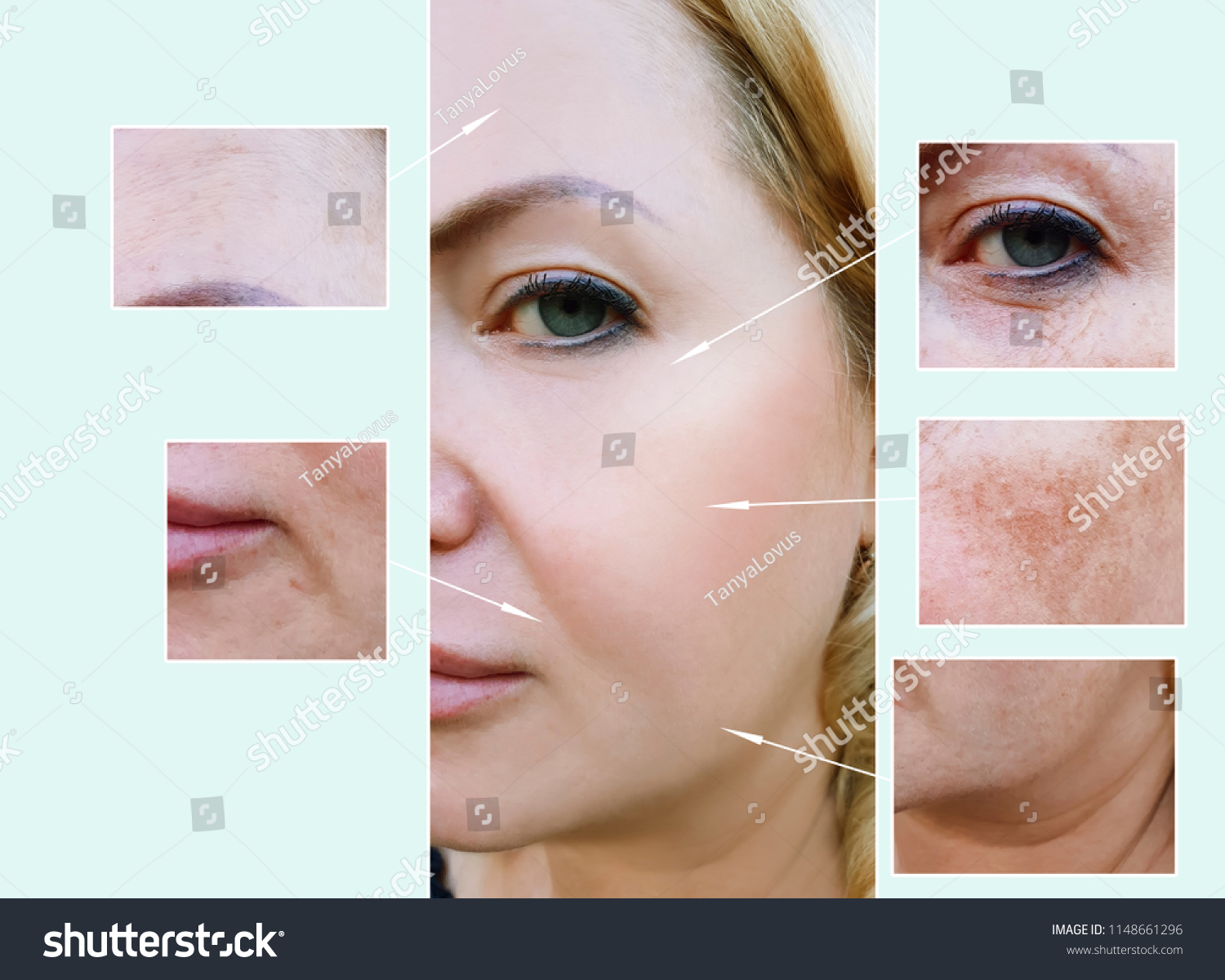 Woman Face Wrinkles Before After Procedures Stock Photo