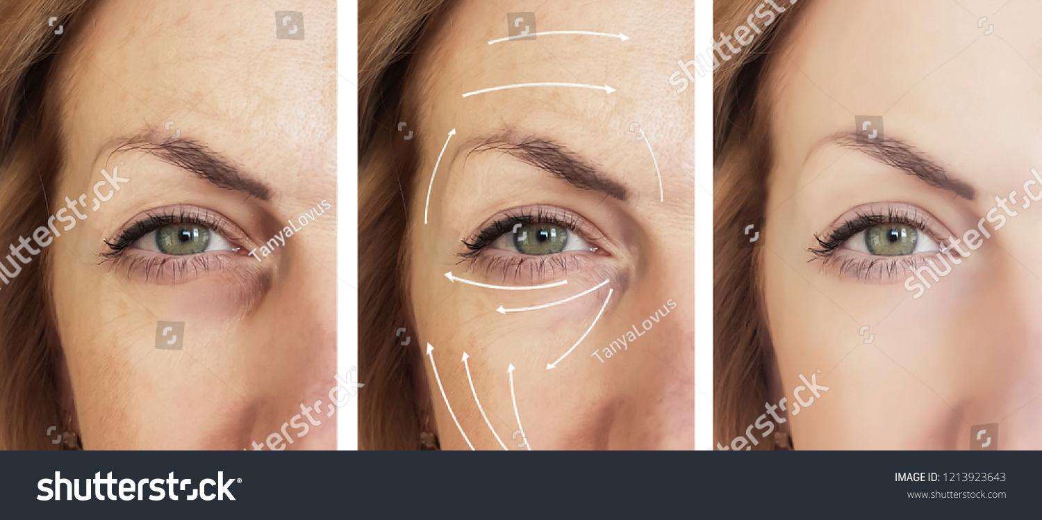 Woman Face Wrinkles Before After Procedures Shutterstock