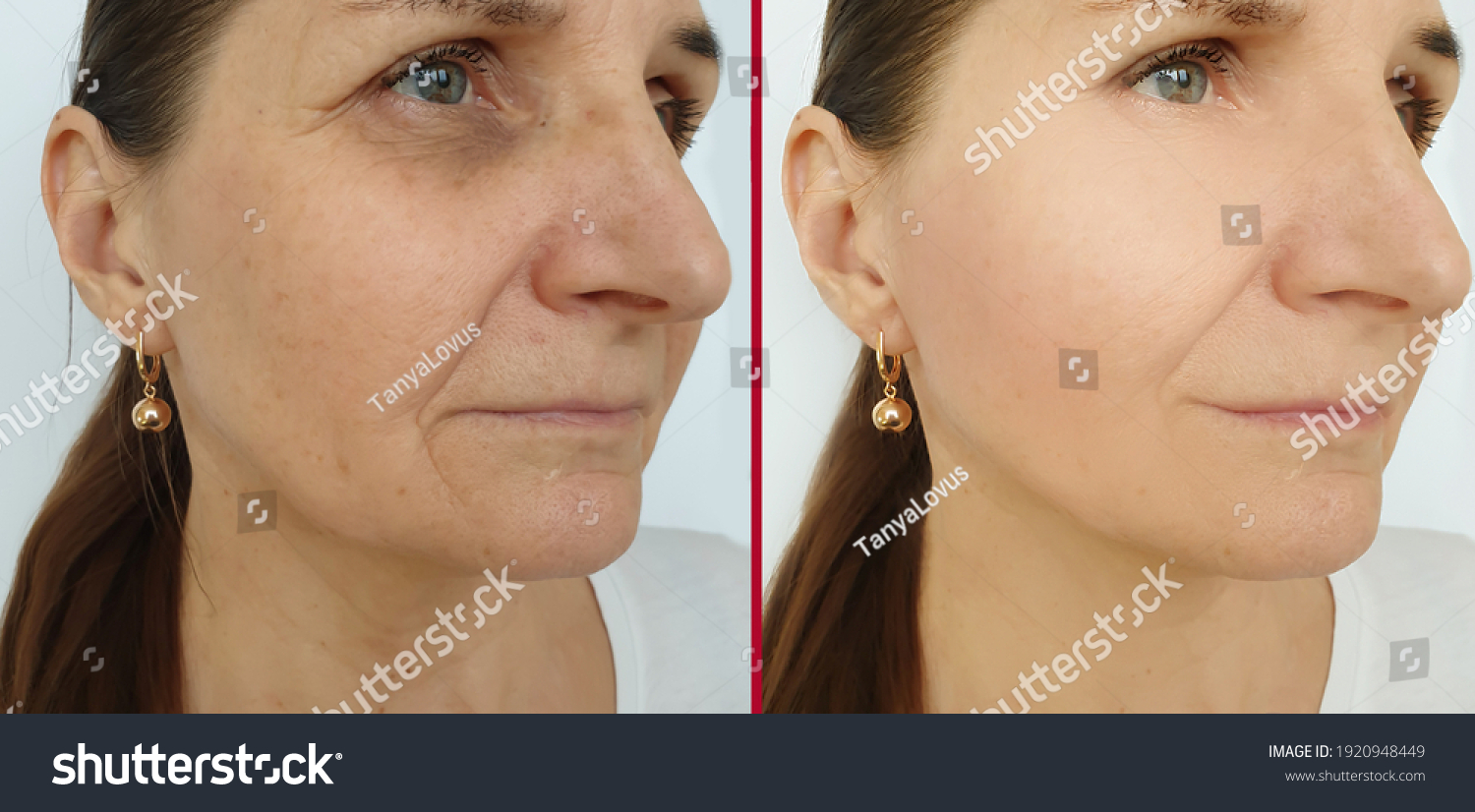 Woman Face Wrinkles Before After Treatment Stock Photo 1920948449