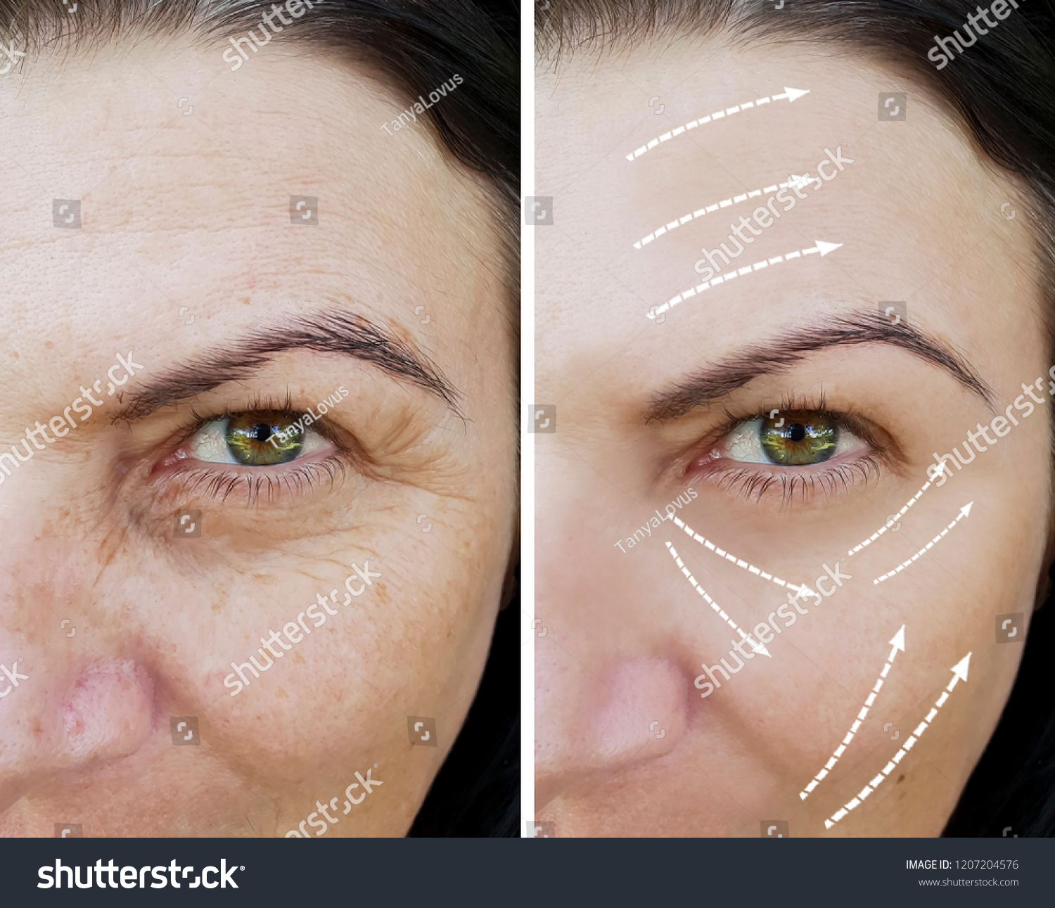 Woman Facial Wrinkles Before After Procedures Stock Photo 1207204576