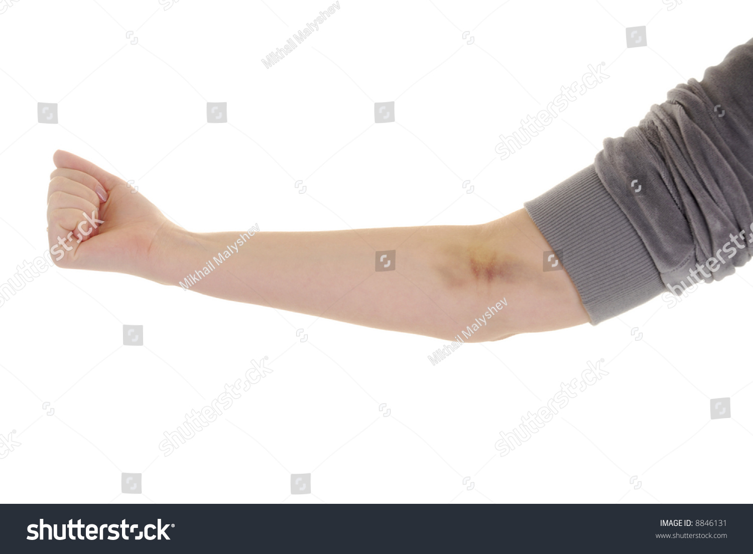 Woman Hand With Bruise Stock Photo 8846131 : Shutterstock