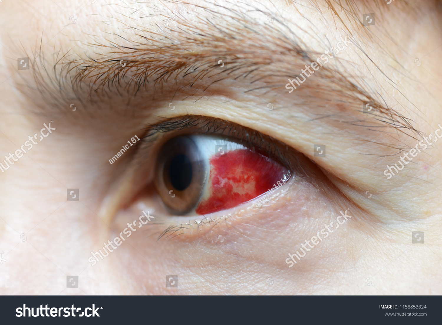 Woman Burst Blood Vessel Eye Closeup Stock Photo 1158853324 Shutterstock