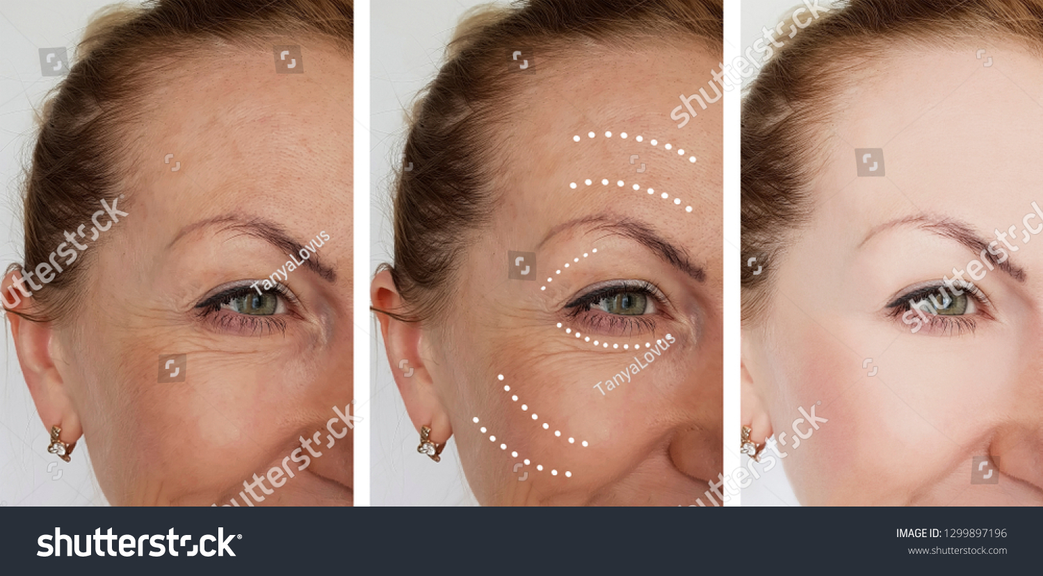 Woman Wrinkles Before After Procedures Stock Photo 1299897196