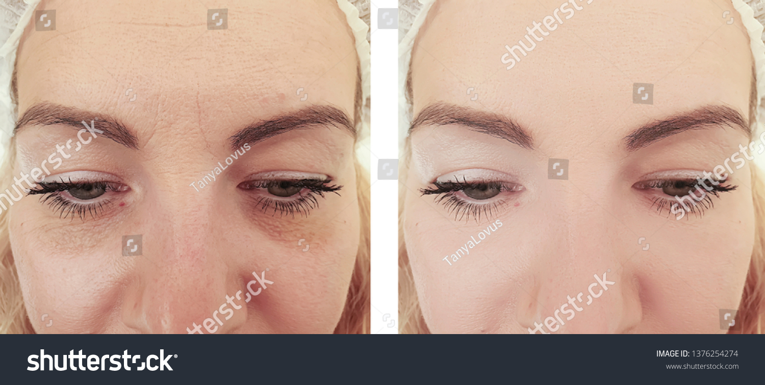 Woman Wrinkles Before After Treatments Stock Photo 1376254274