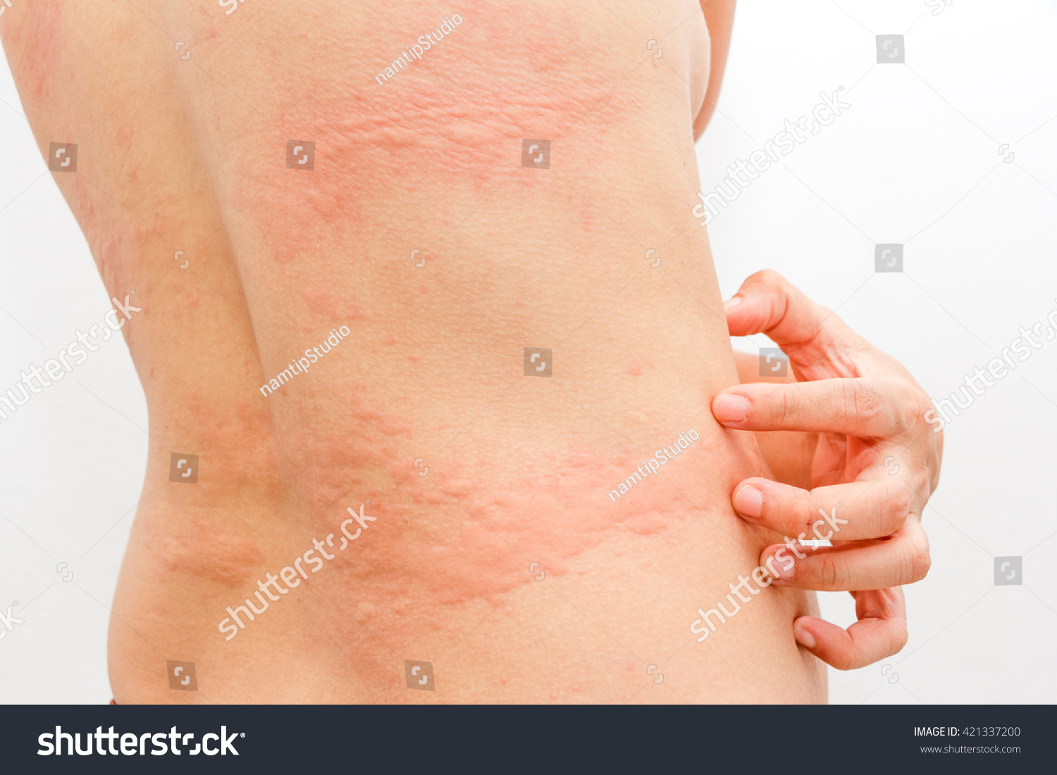 Women with symptoms of itchy urticaria.