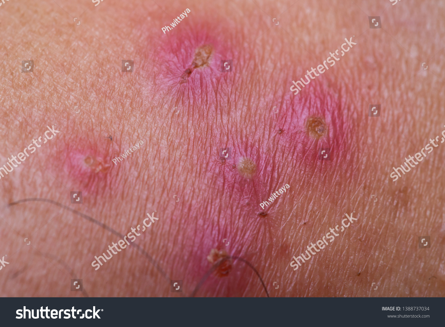 Wound Infection On Skin Skin Lesions Stock Photo (Edit Now) 1388737034