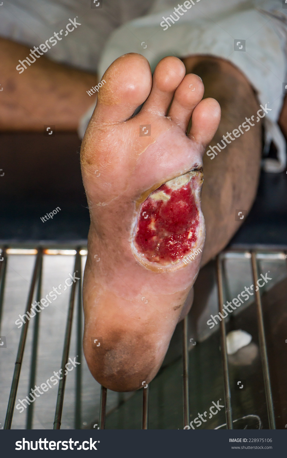 Wound Diabetic Foot Stock Photo 228975106 - Shutterstock