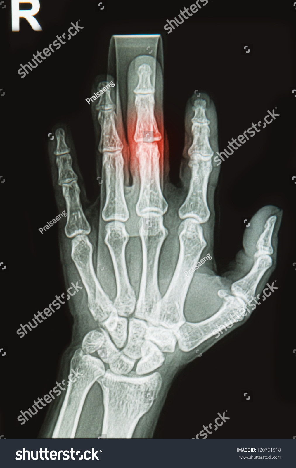 Wrist Hand Xrays Image Show Fracture Stock Photo 120751918 - Shutterstock