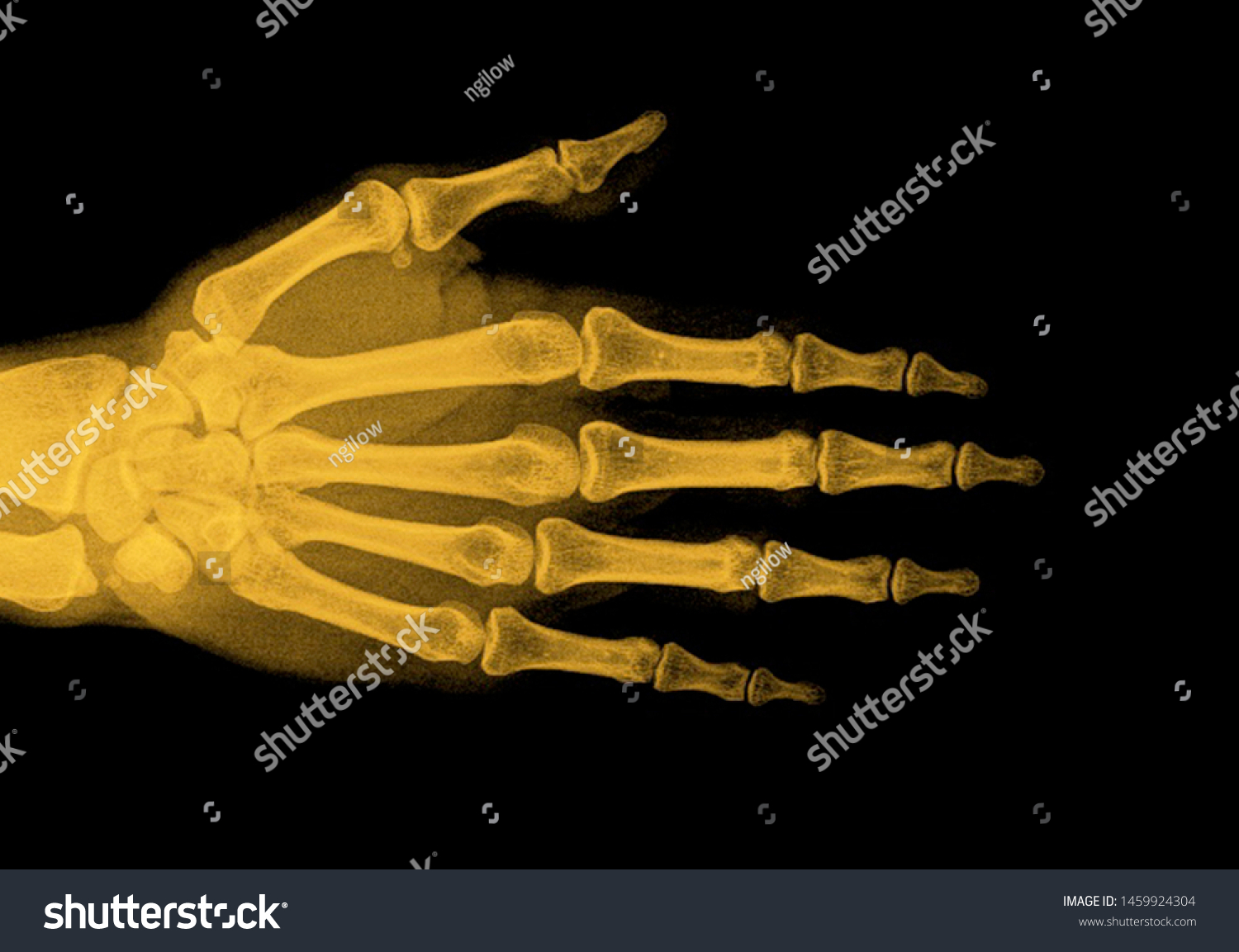 Wrist X Ray Anatomy Radiology Radiographic Foto Stock 1459924304