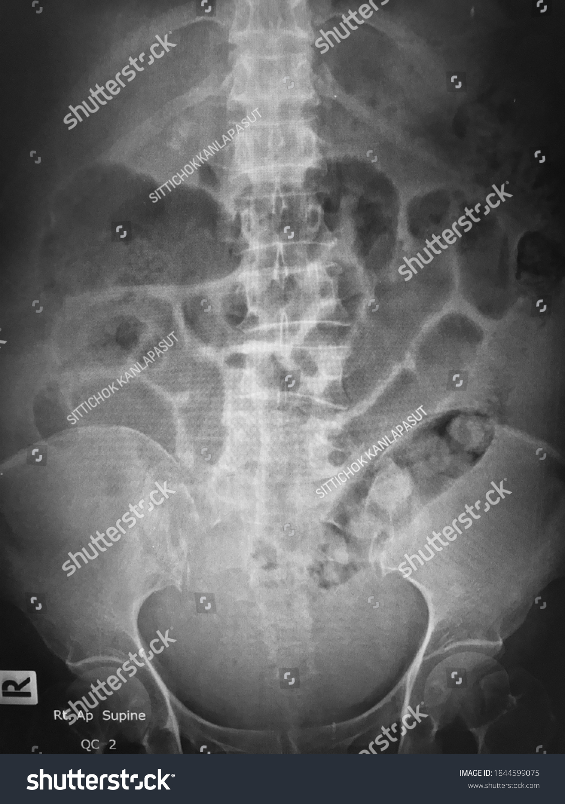 Xray Abdomen Supine Position Image Stock Photo 1844599075 | Shutterstock