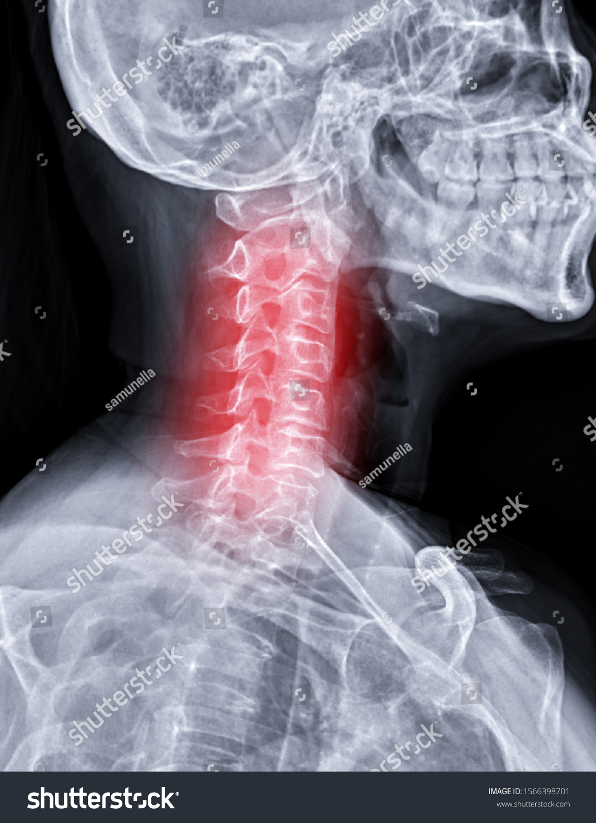 Xray Cspine Xray Image Cervical Spine Stock Photo 1566398701 | Shutterstock