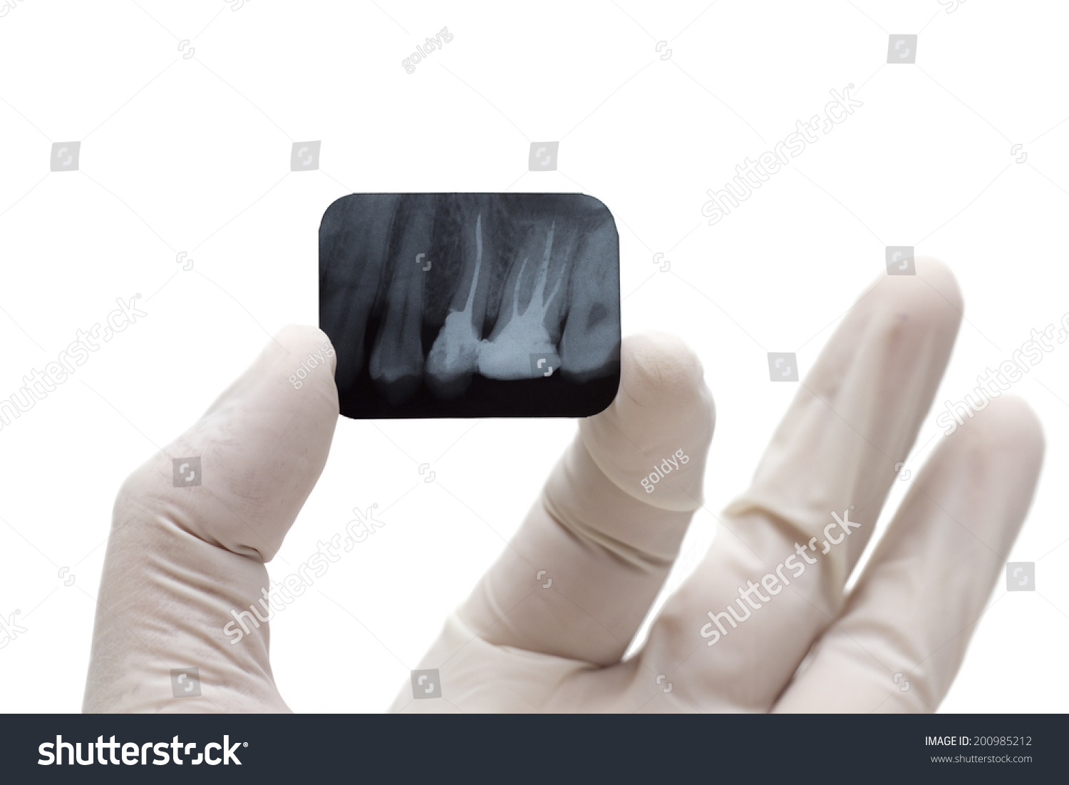 Xray Dental Isolated On White Background Stock Photo (Edit Now) 200985212