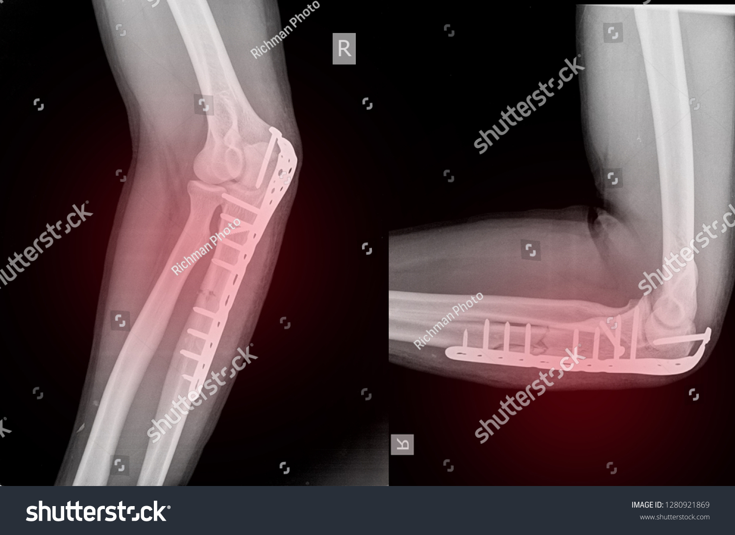 Xray Elbow Olecranon Fracture My Be Stock Photo 1280921869 Shutterstock Xray Elbow Olecranon Fracture My Be Stock Photo 1280921869 Shutterstock