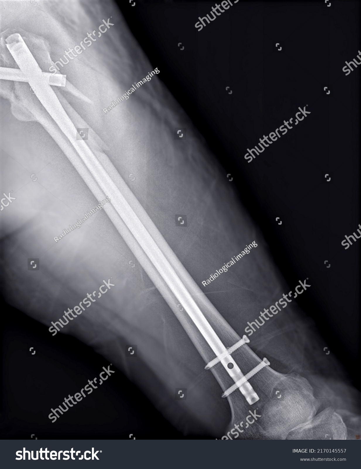 Xray Femur Bone Fracture After Total Stock Illustration