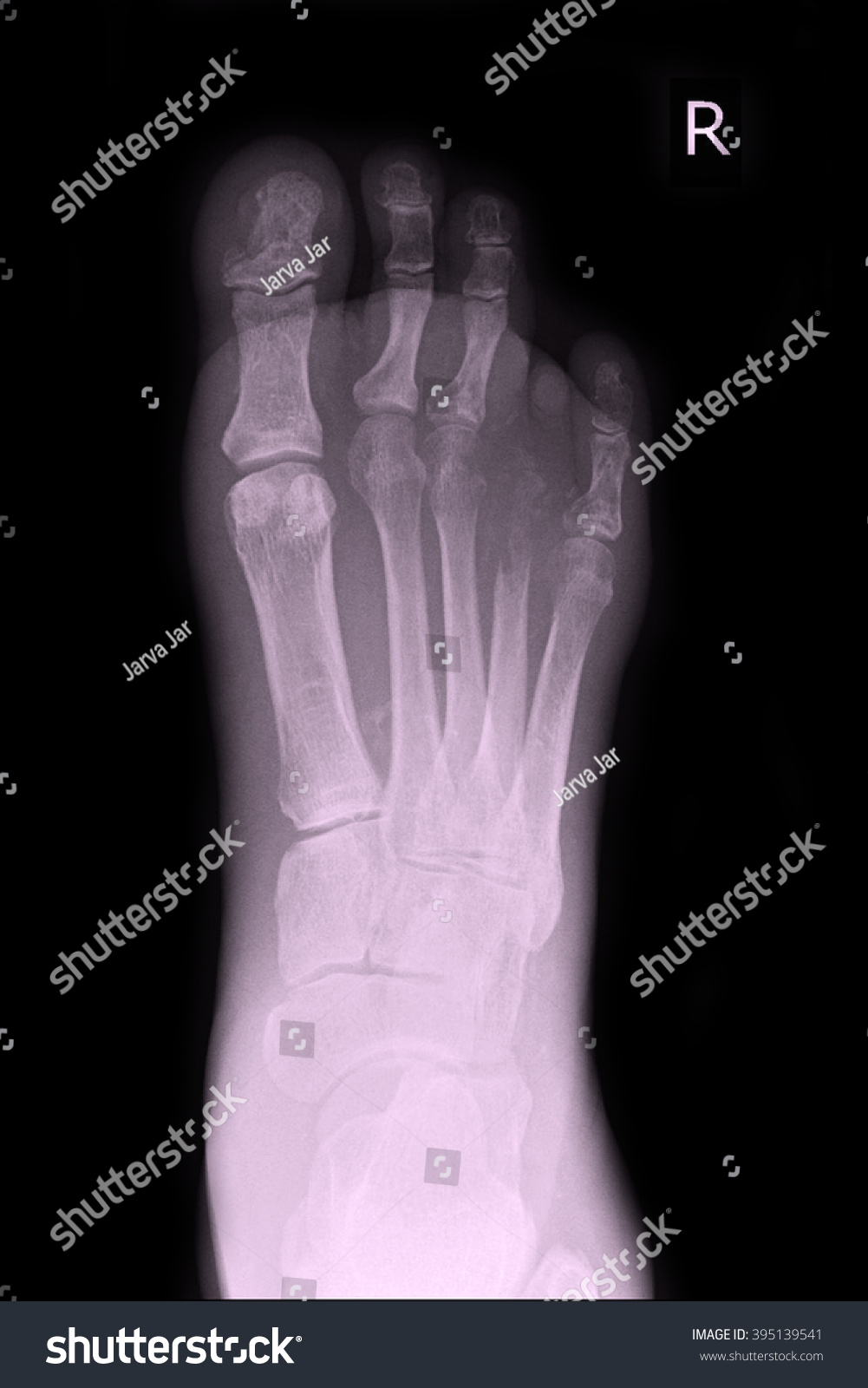 Xray Foot Show Gangrene 2rd3nd Toe Stock Photo (Edit Now) 395139541