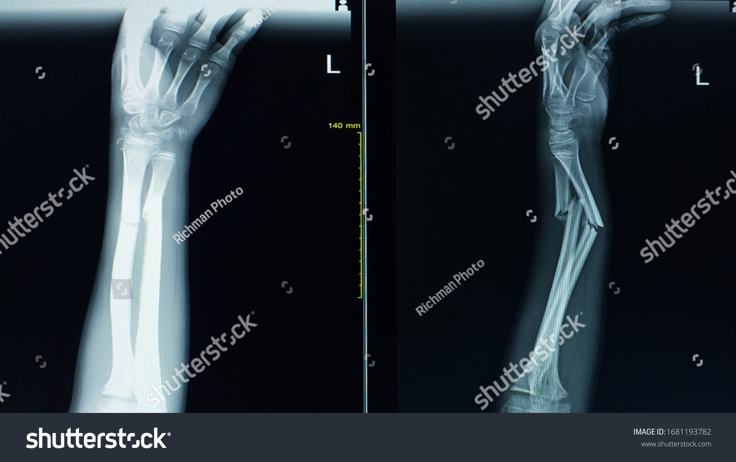 Xray Forearm Aplateral View Case Accident Stock Photo 1681193782 ...