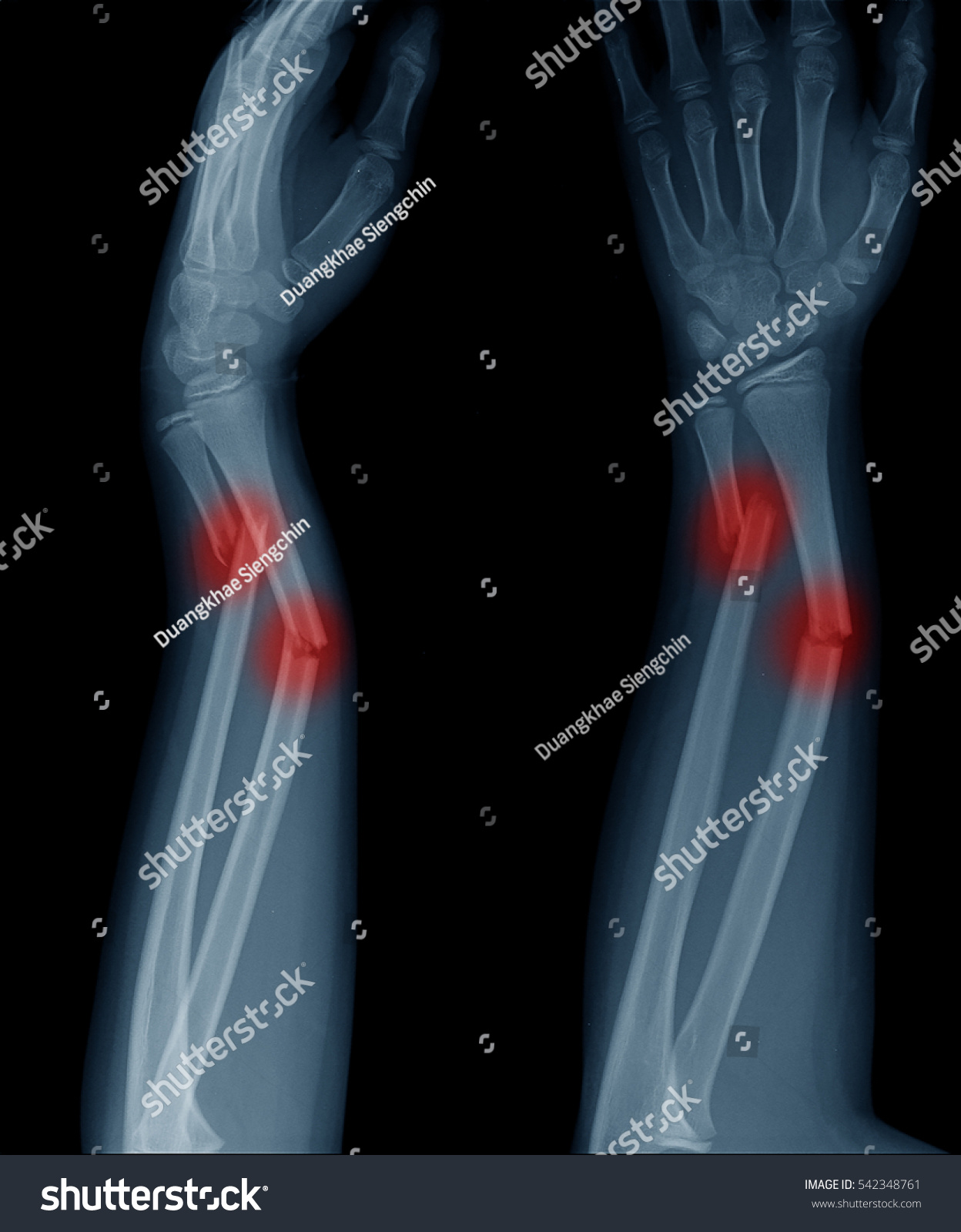 Xray Forearm Fracture Child Stock Photo 542348761 - Shutterstock