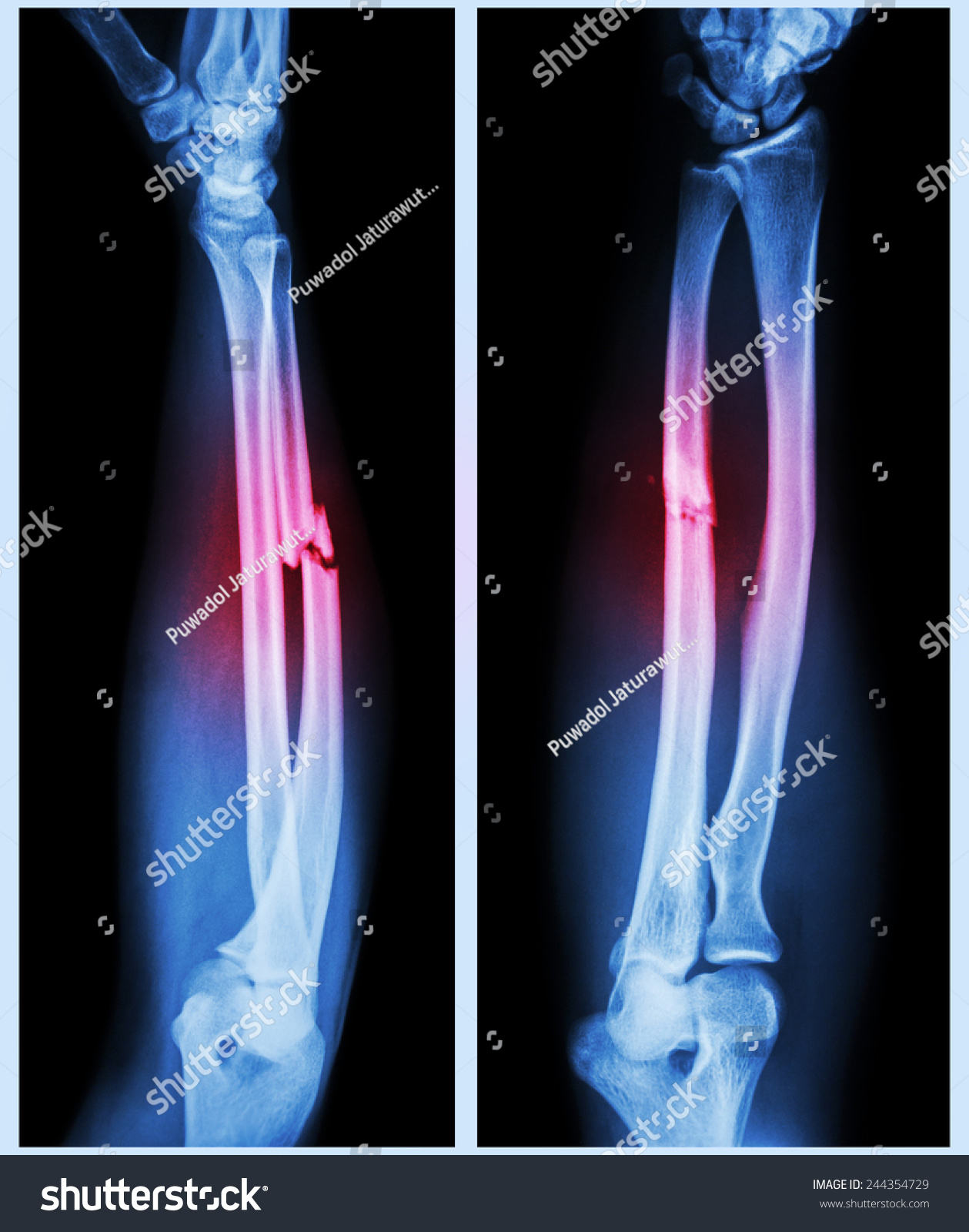 X-Ray Forearm ( Front , Side ) : Comminuted Fracture Shaft Of Ulnar ...