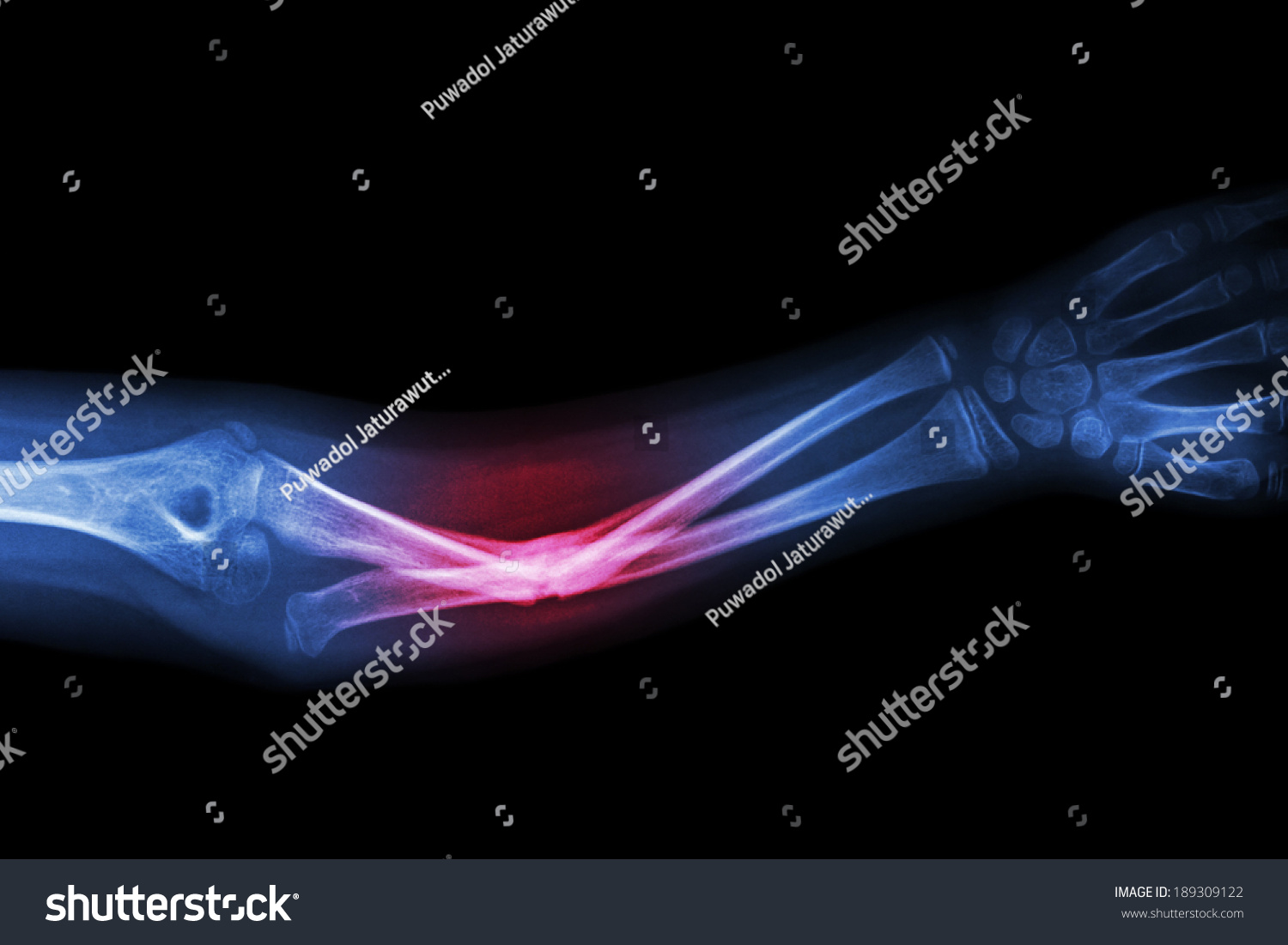 X-Ray Fracture Ulnar Bone (Forearm Bone) Stock Photo 189309122 ...