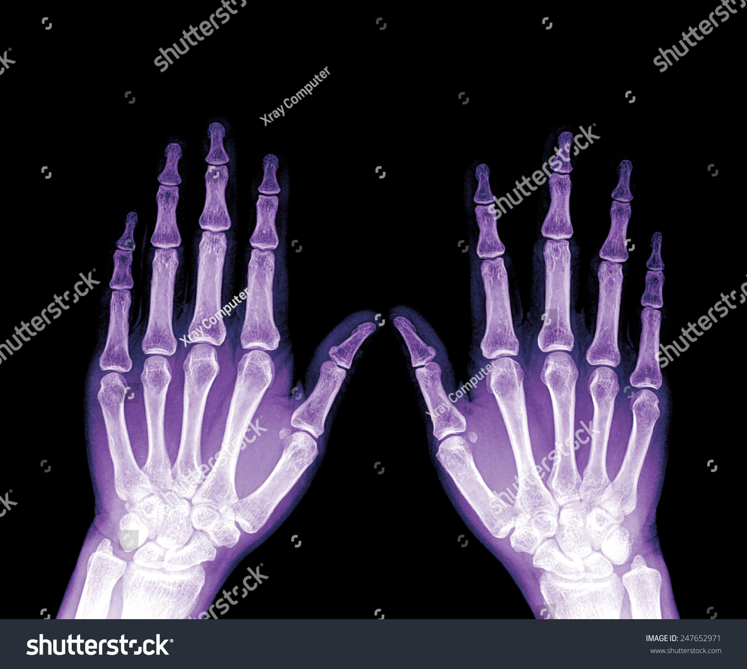 Xray Hands Front View Normal Human Stock Photo 247652971 | Shutterstock