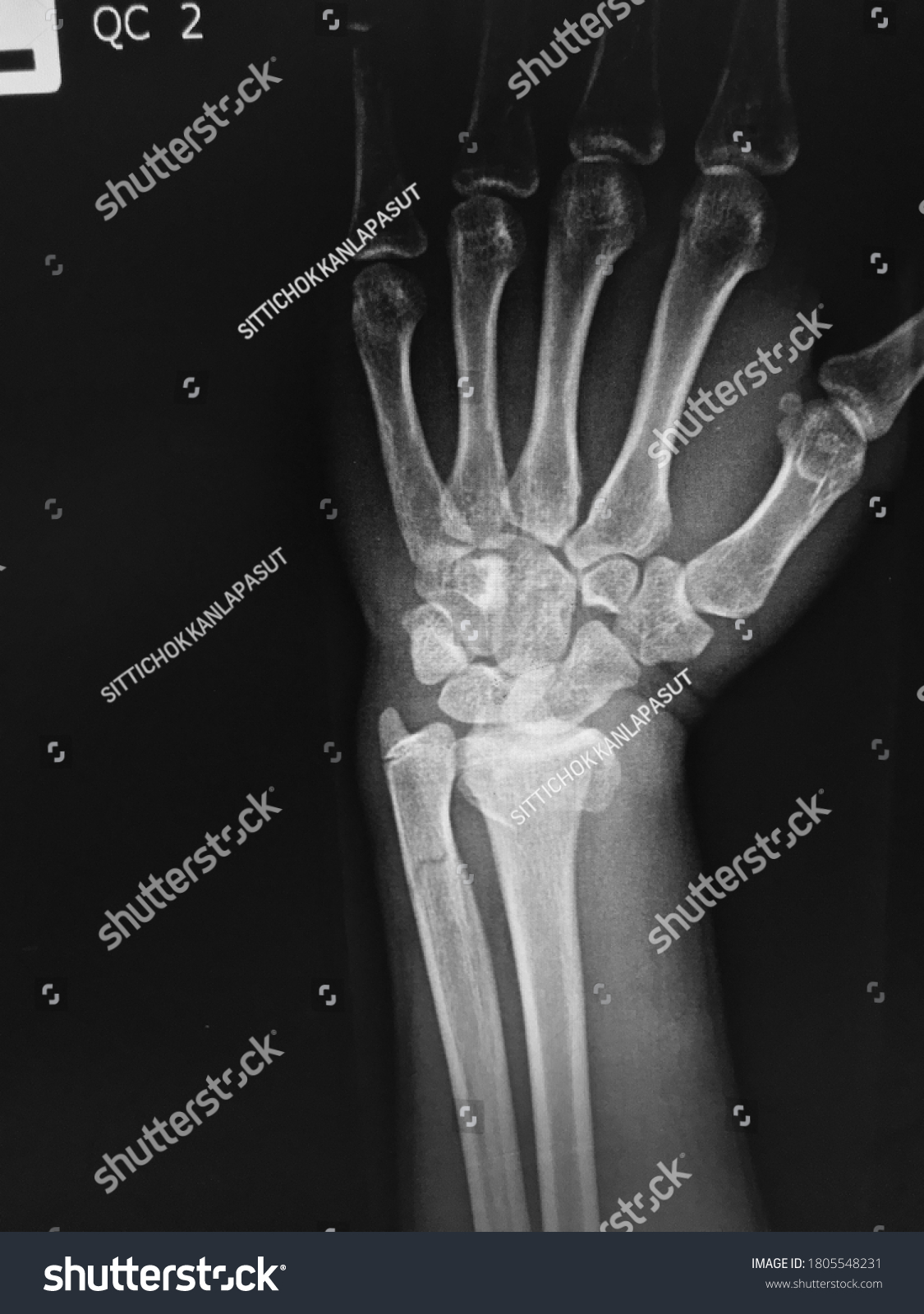 Xray Human Hand Xray Hand Bones Stock Photo (Edit Now) 1805548231