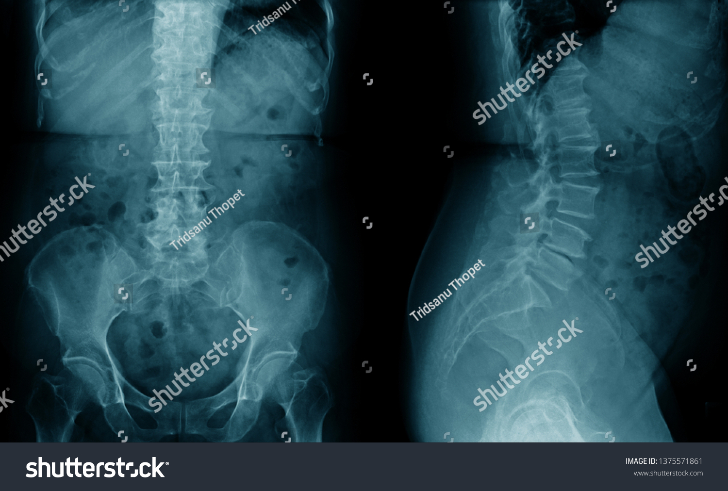 Xray Human Spine Ap Lateral View Stock Photo (Edit Now) 1375571861